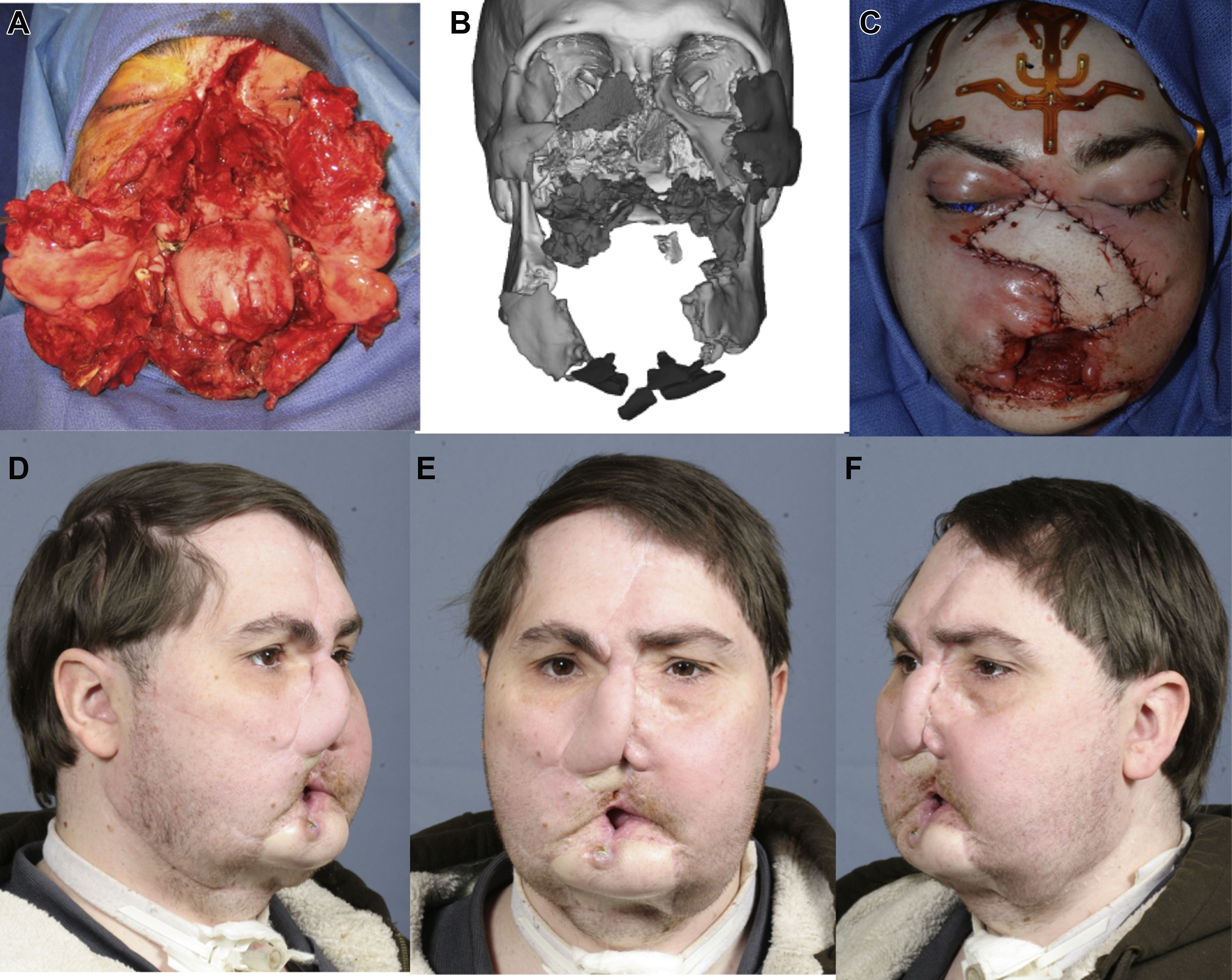 Gun blast injury after surgery Scrolller