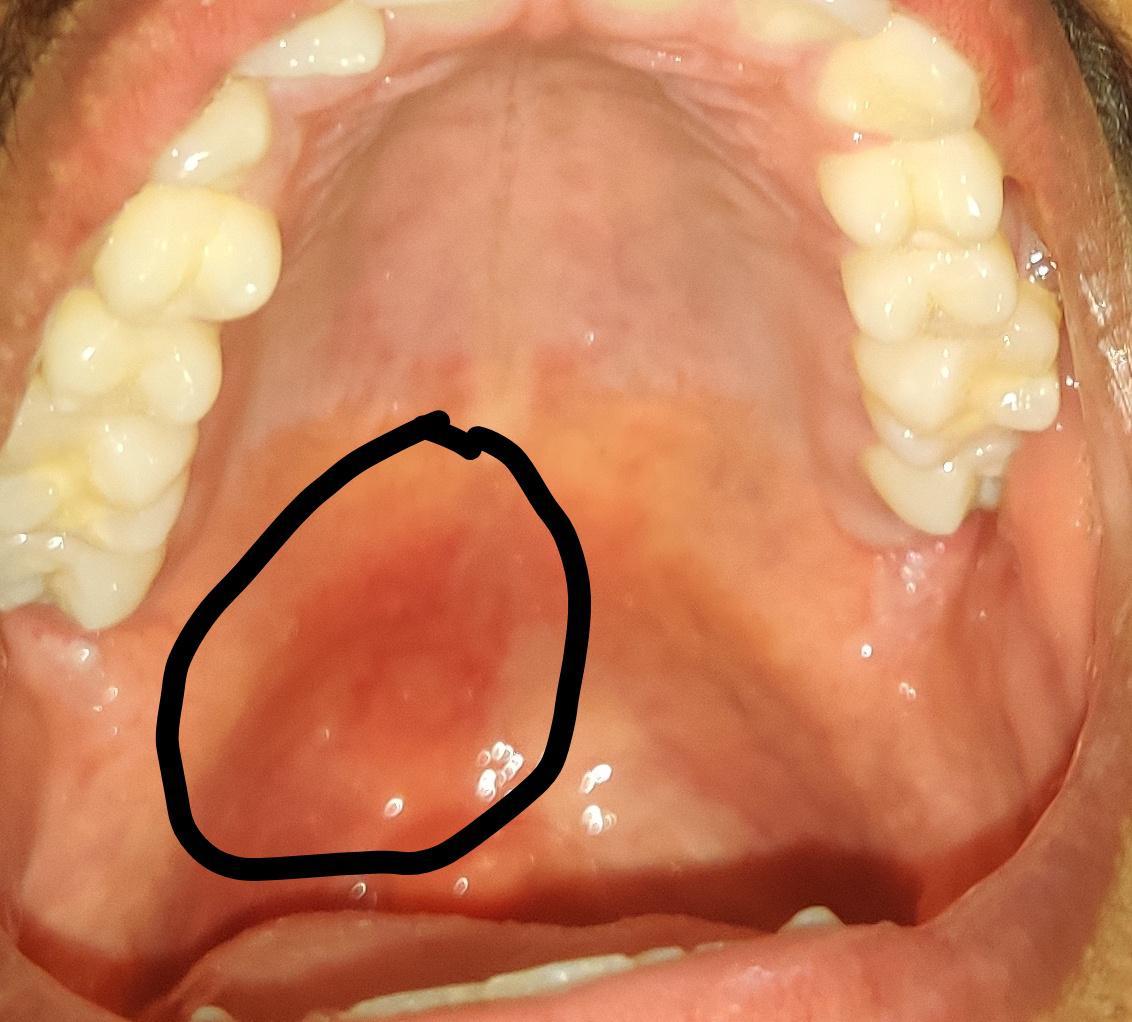I have a bruise on my palate, is this normal? What should I do? Scrolller