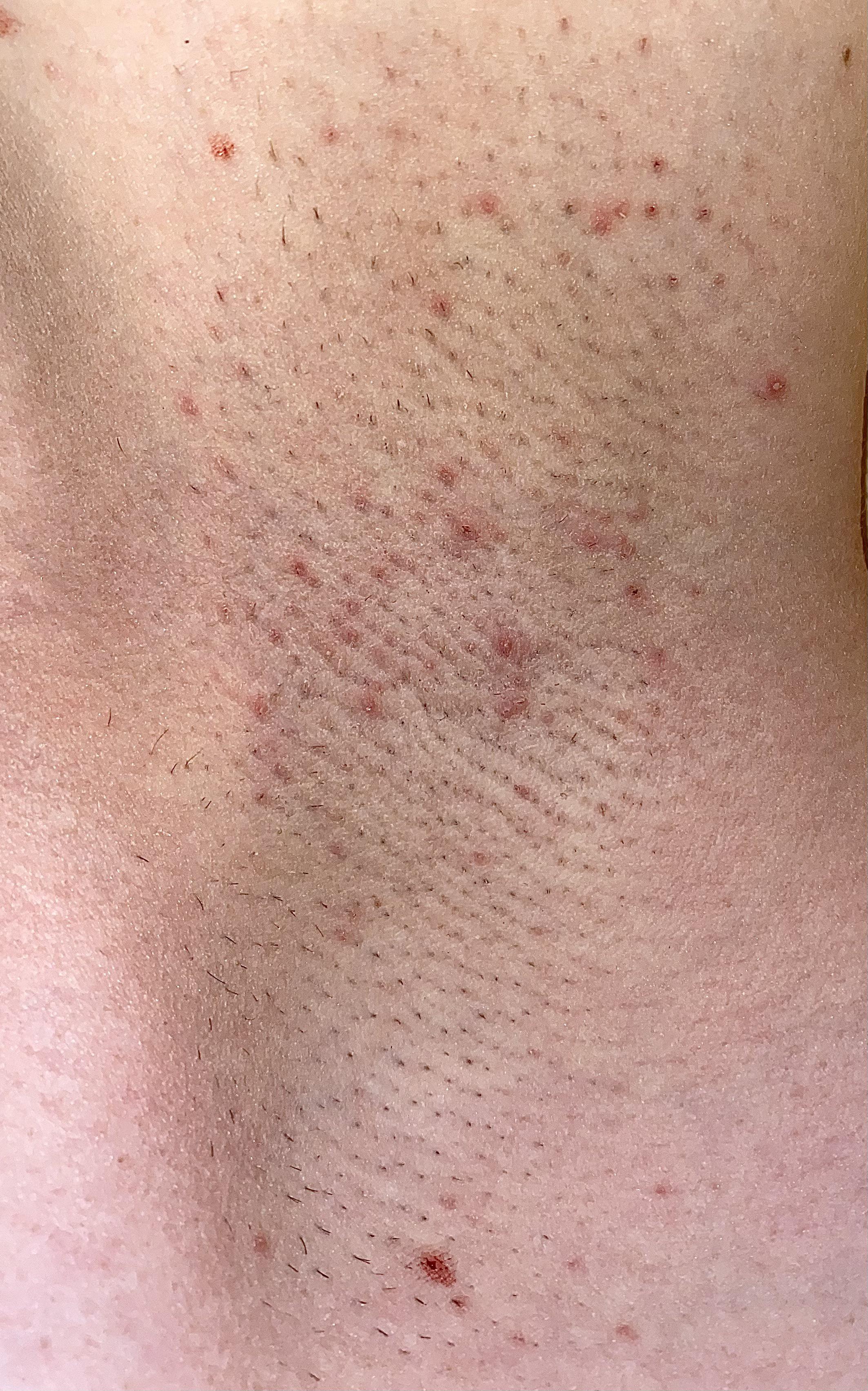 I was stupid and shaved with a dull razor and did this to my armpits 😢 ...