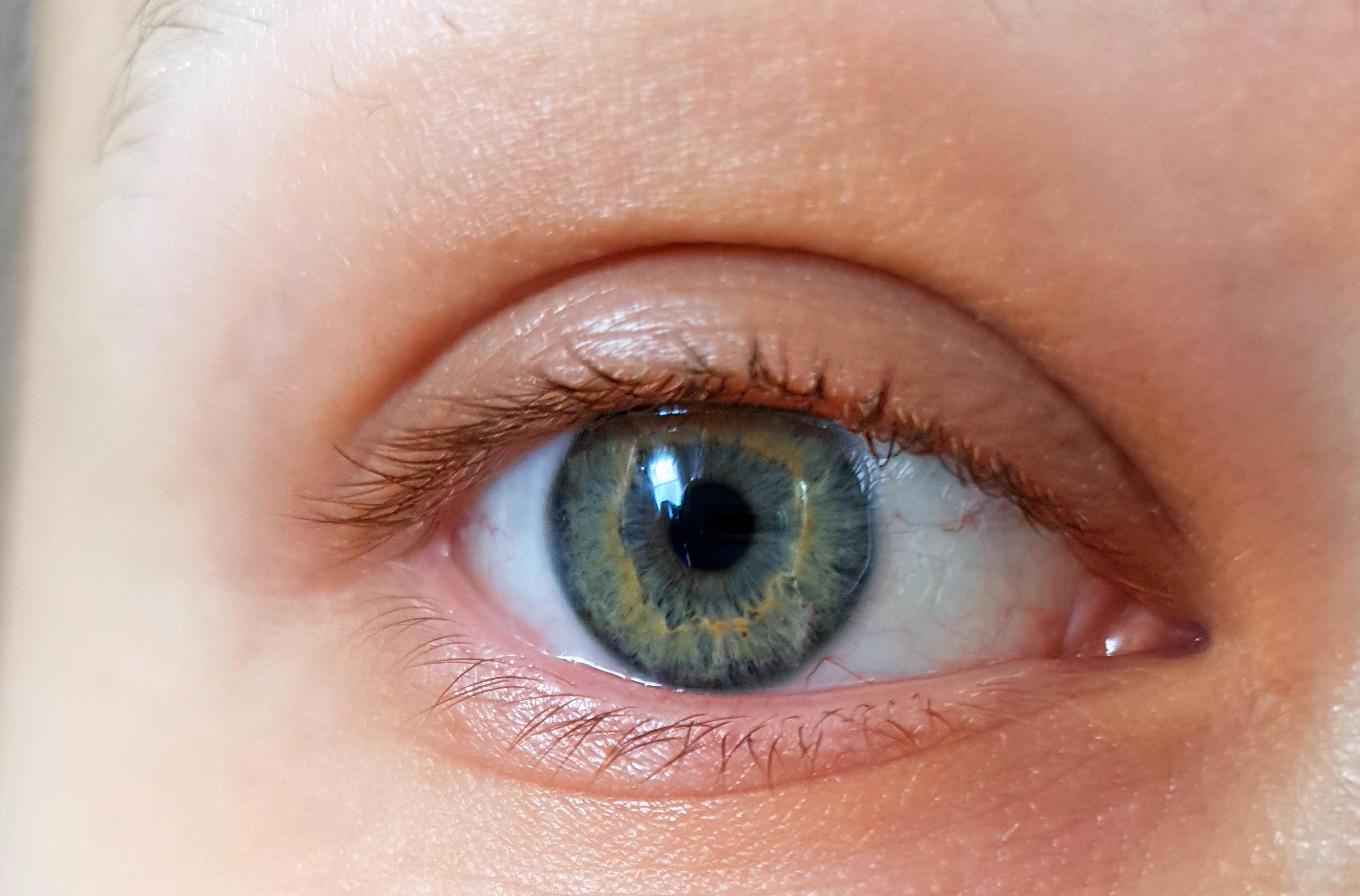 Chloropia Is this central heterochromia or just green? My eyes changes shades of ...