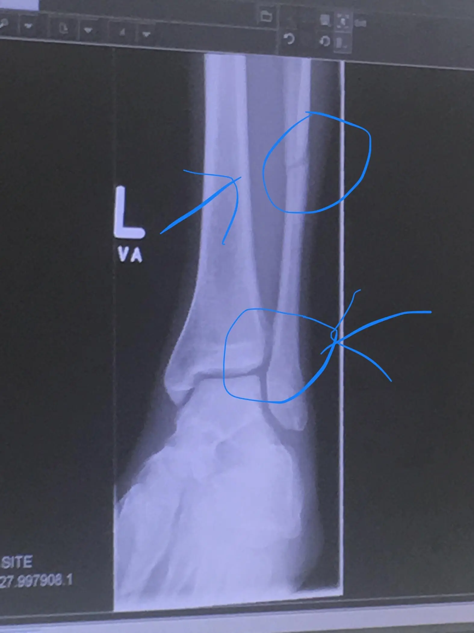 Discover more like Brokenbones: Messed up my leg playing soccer anyone ...
