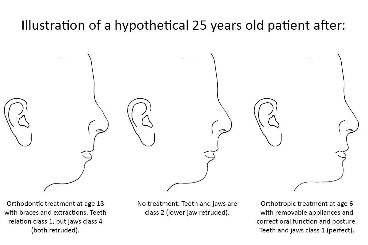 New Post What is Orthotropics and how is it different than