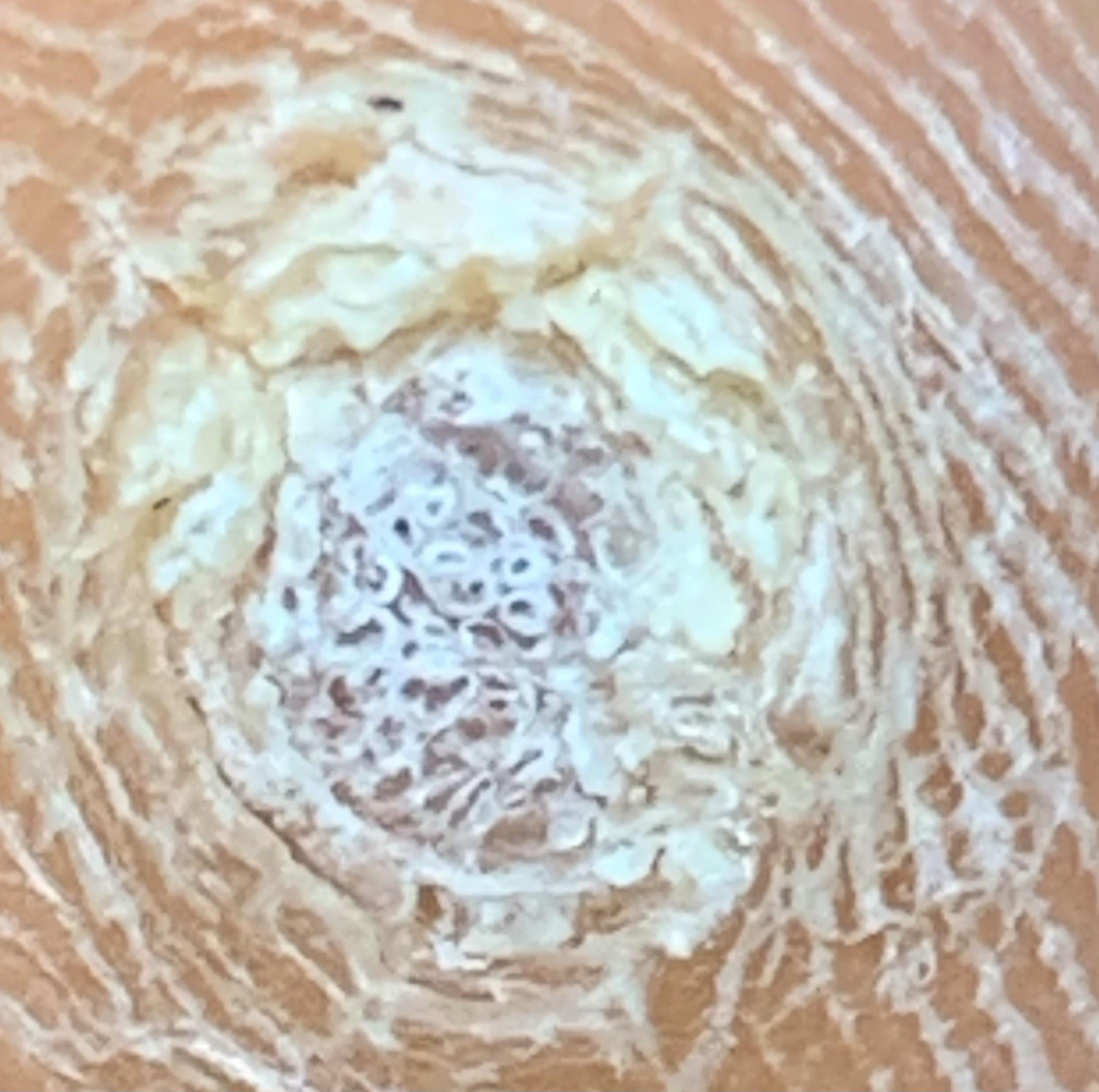 Plantar wart up close Scrolller
