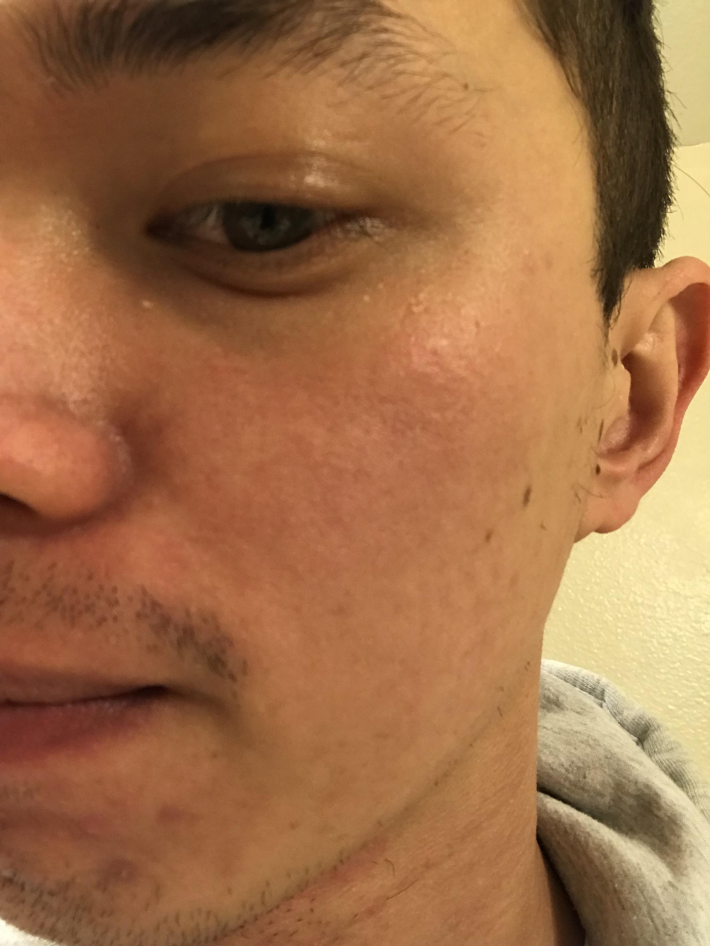 Redness won't go away....Feeling helpless Scrolller