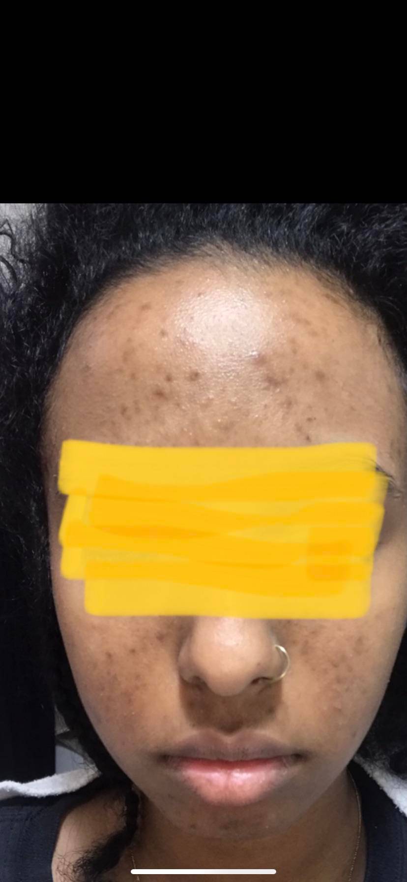 skin-concerns-struggling-with-hyperpigmentation-any-suggestions-i