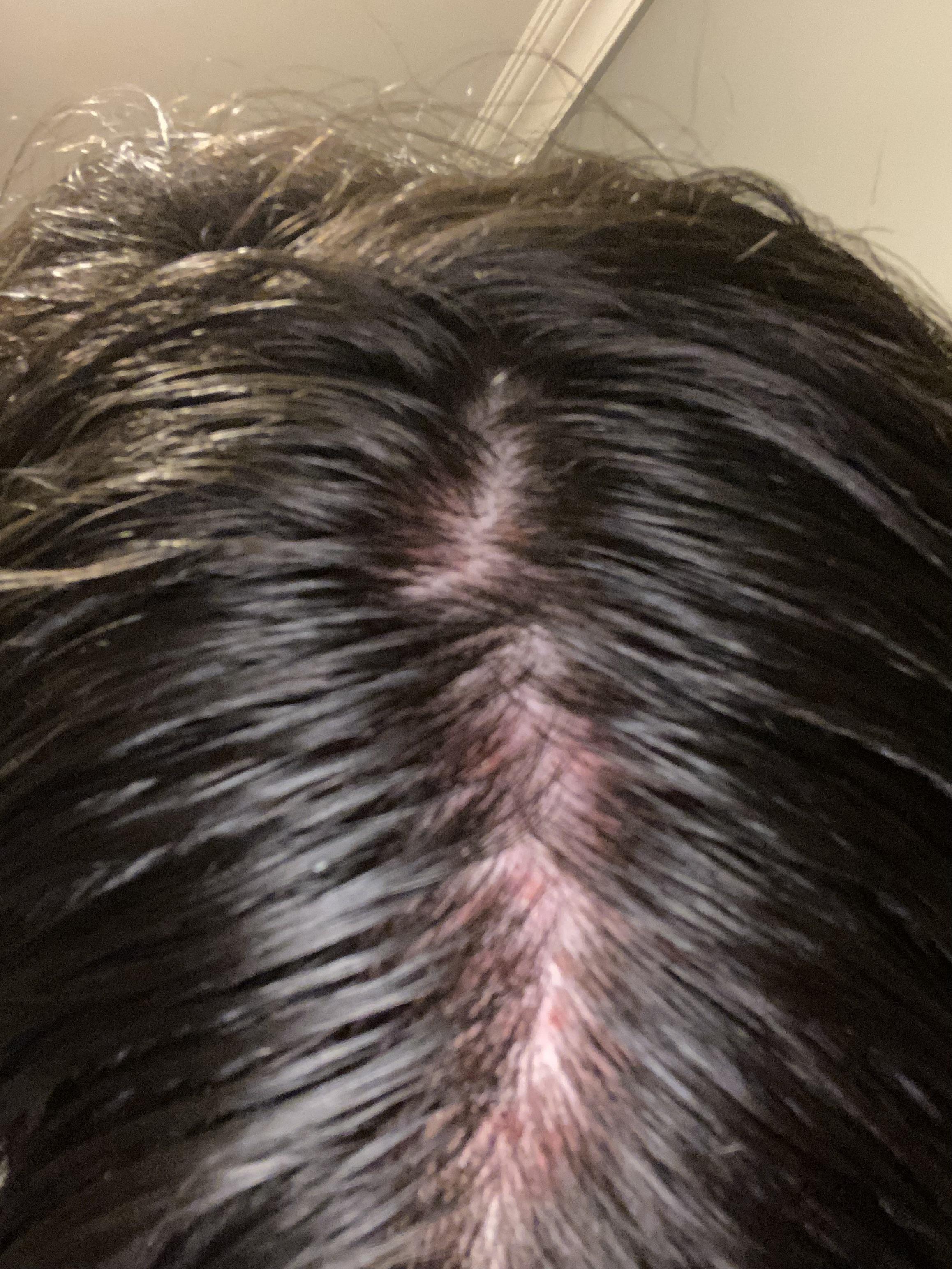 So…this happened on my scalp?! Help. Scrolller