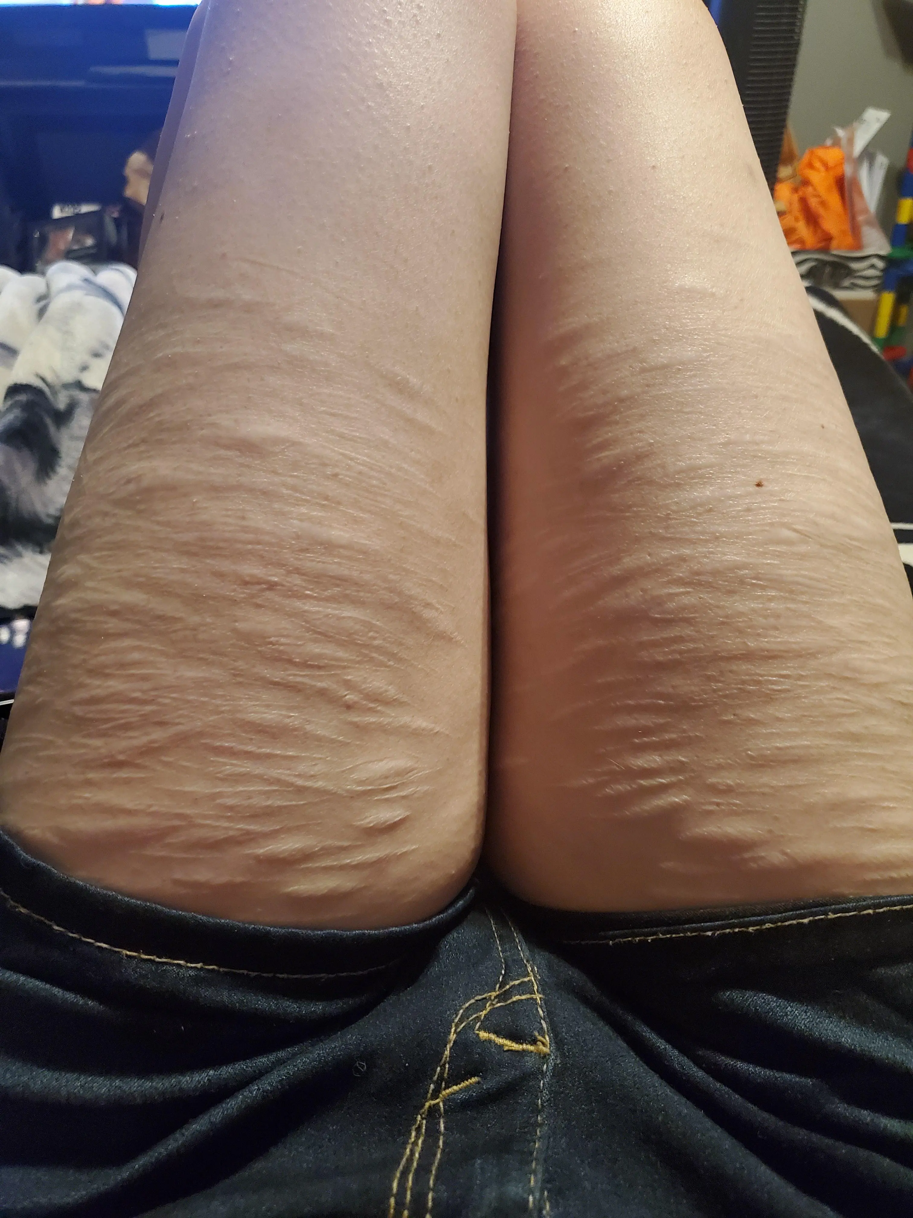 Sometimes I'm still insecure about these scars. But its getting better ...