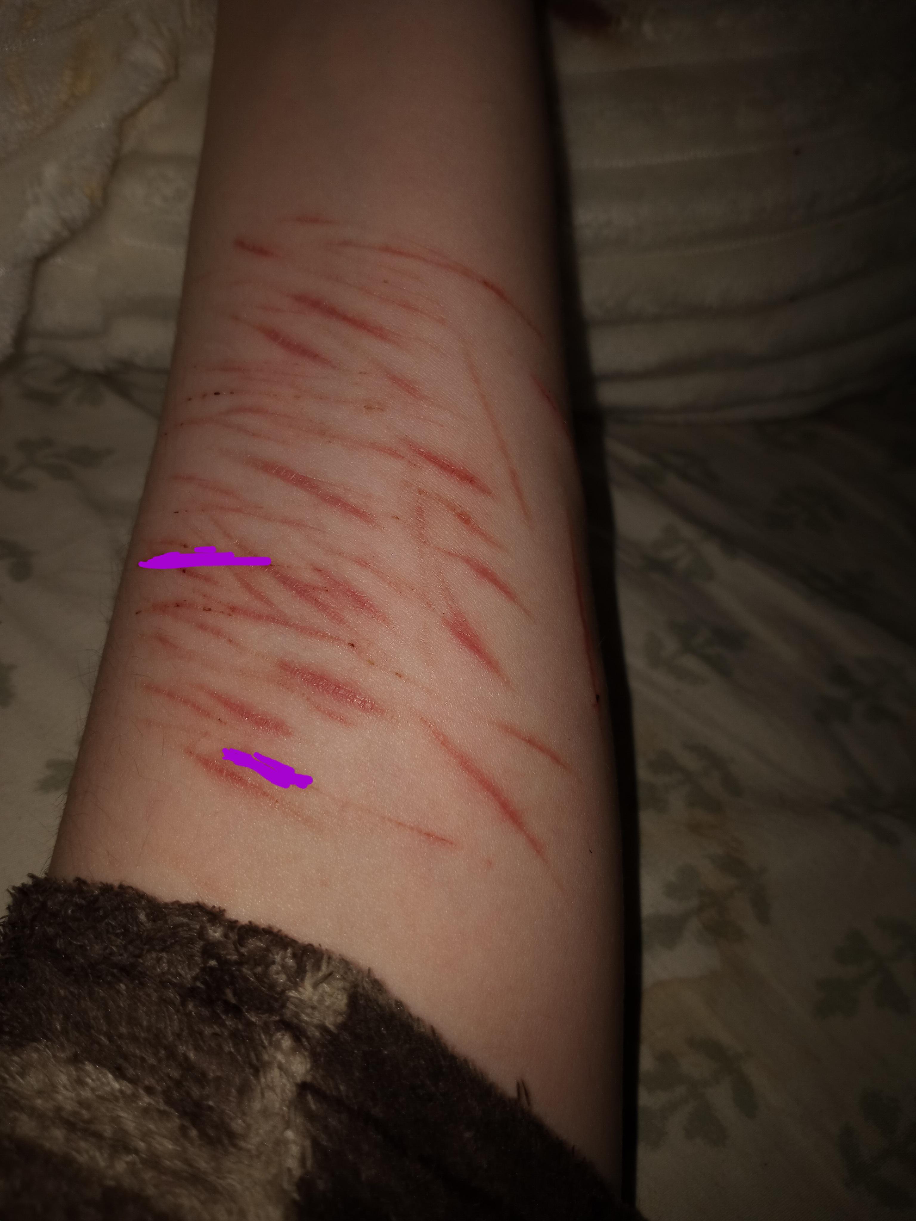 These were shallow styro cuts. These will most likely completely fade ...
