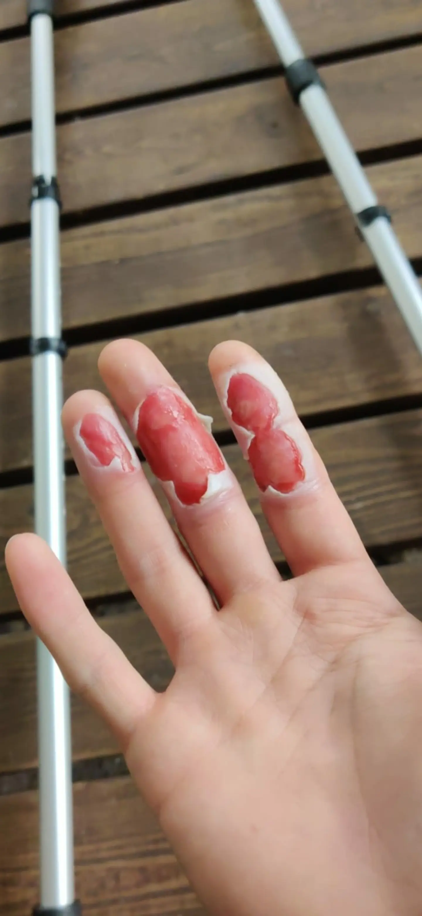 Throwback to when I fell hand first to a stove.