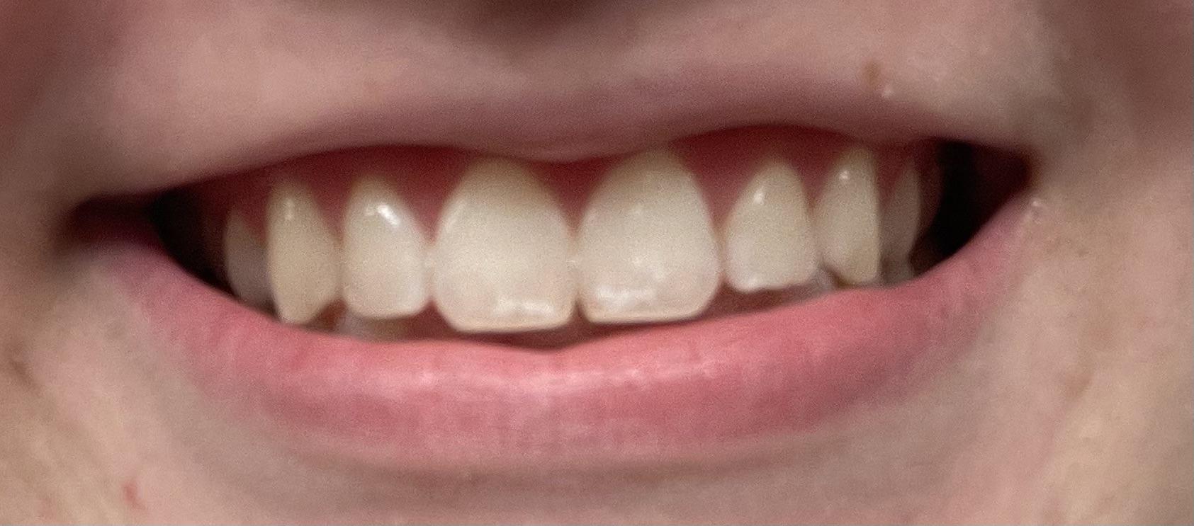 White spots on front of teeth… I used Crest 3D white strips for the first time and these spots