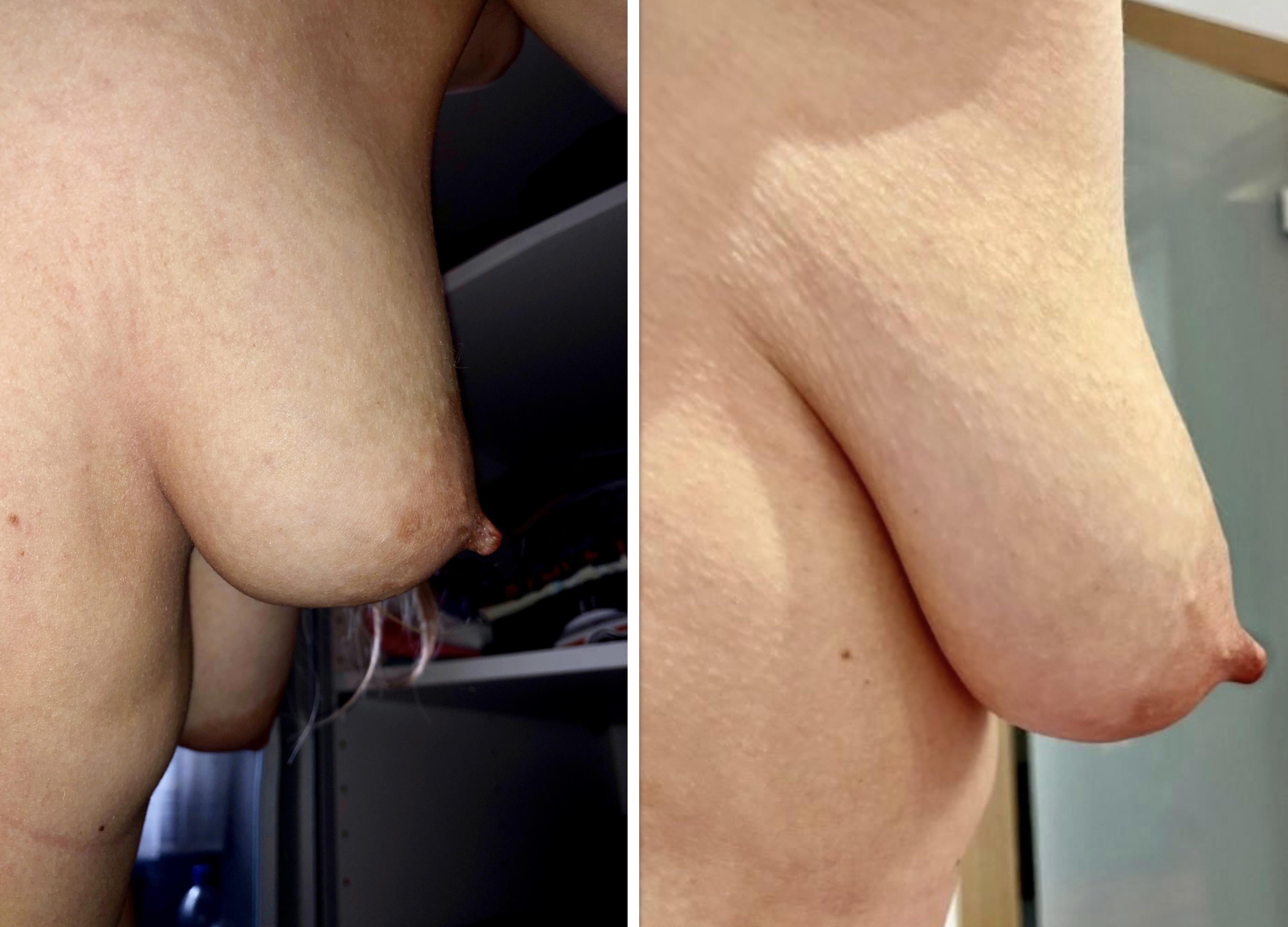 Before and after size increase