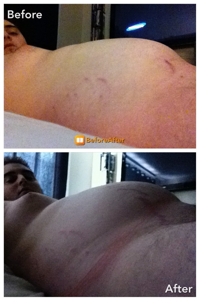 Weight gain Before/After