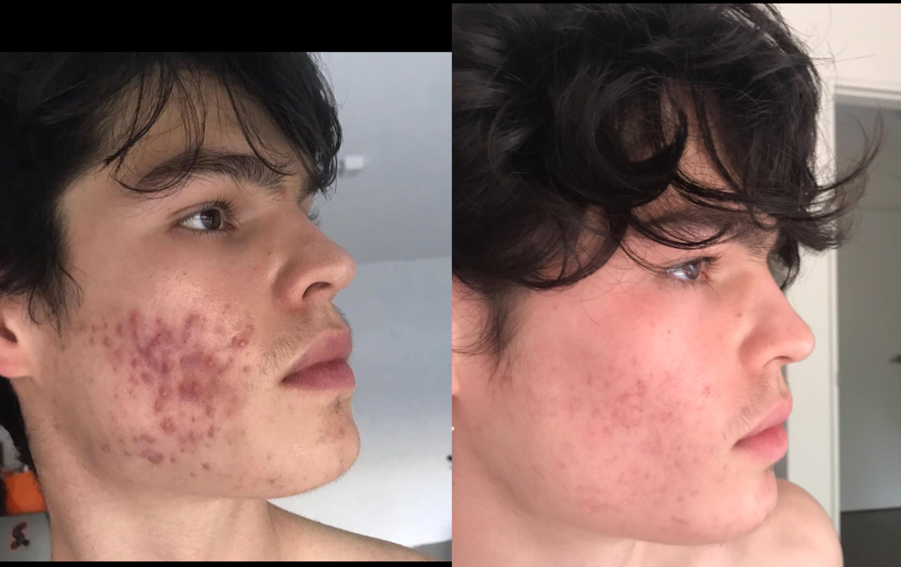 1 Week before treatment vs 4.5 Months in | Scrolller
