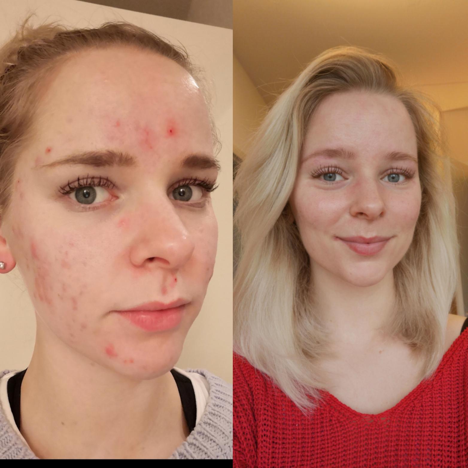 10 Months In First Time In Public Without Foundationbb Cream Scrolller 