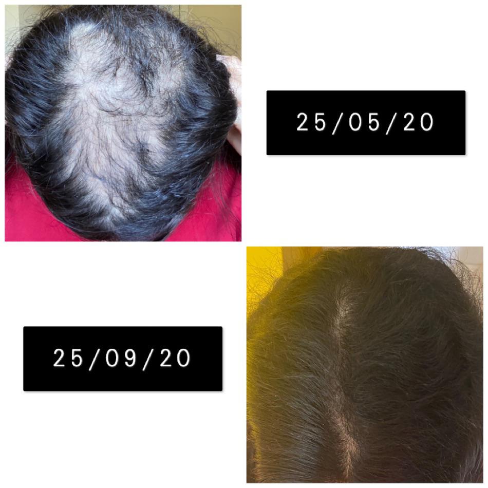 Treatment for Hair Growth After Trichotillomania