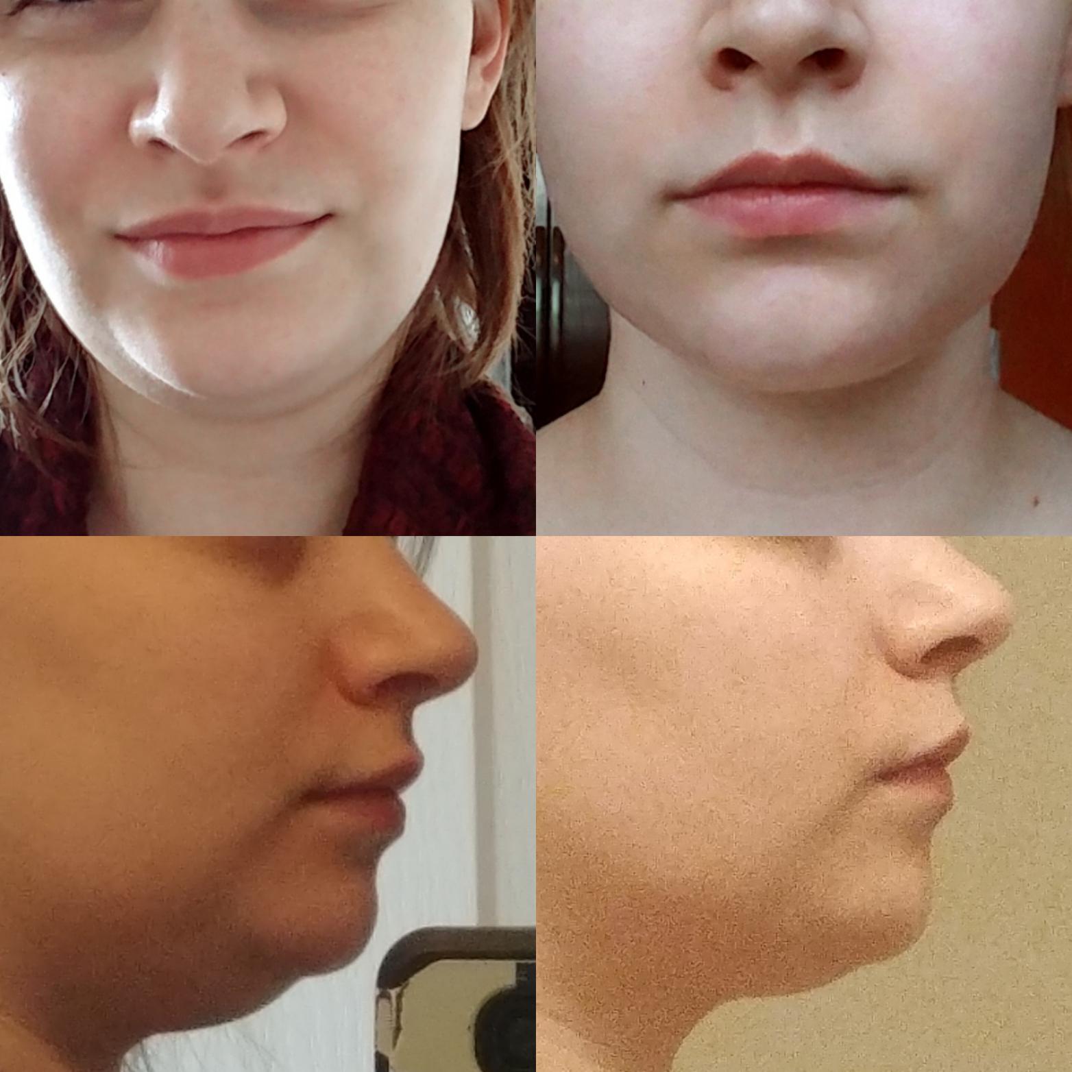 6 weeks post op Chin lipo Scrolller