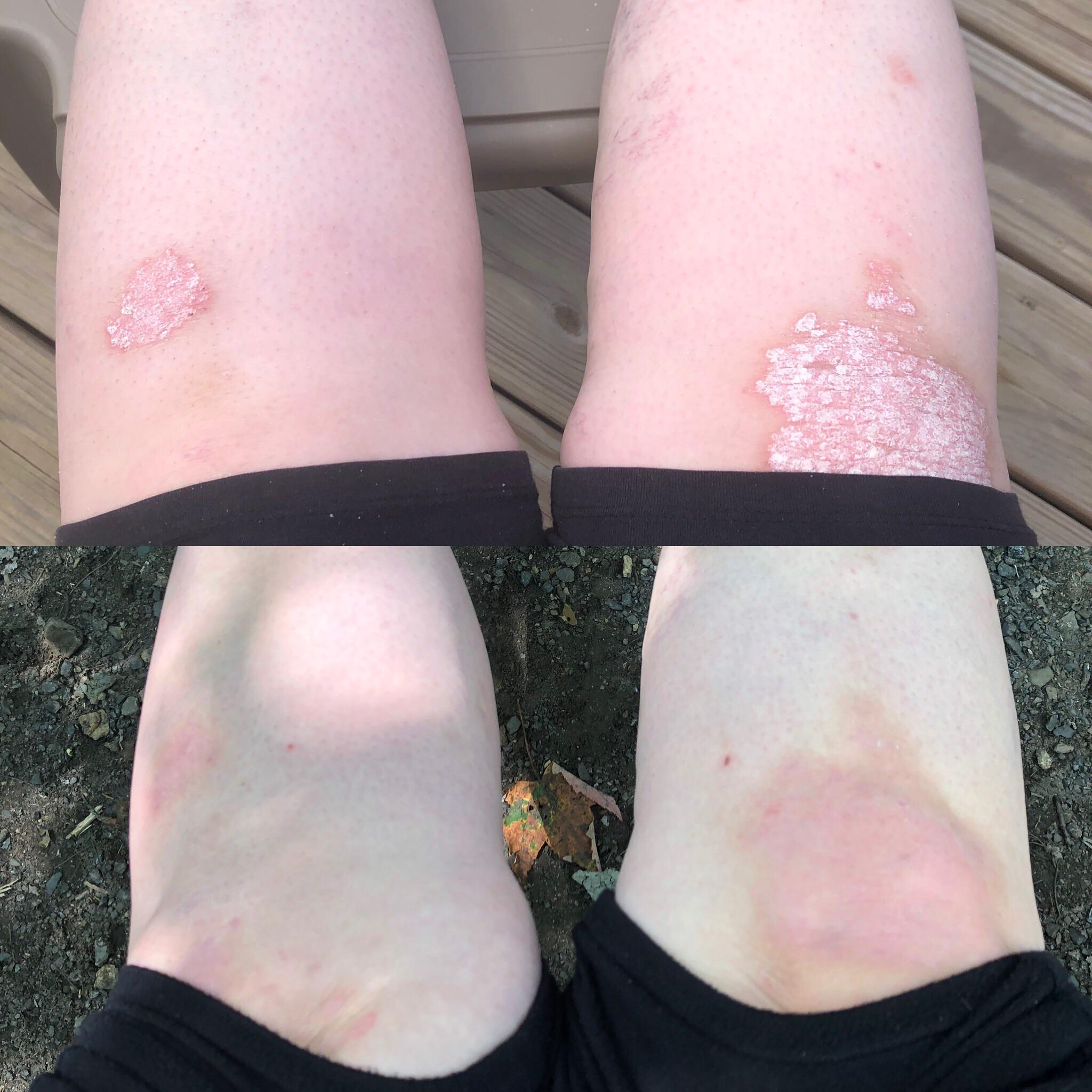 Cosentyx Rash Before and after the 5 Cosentyx loading doses! So impressed with the ...