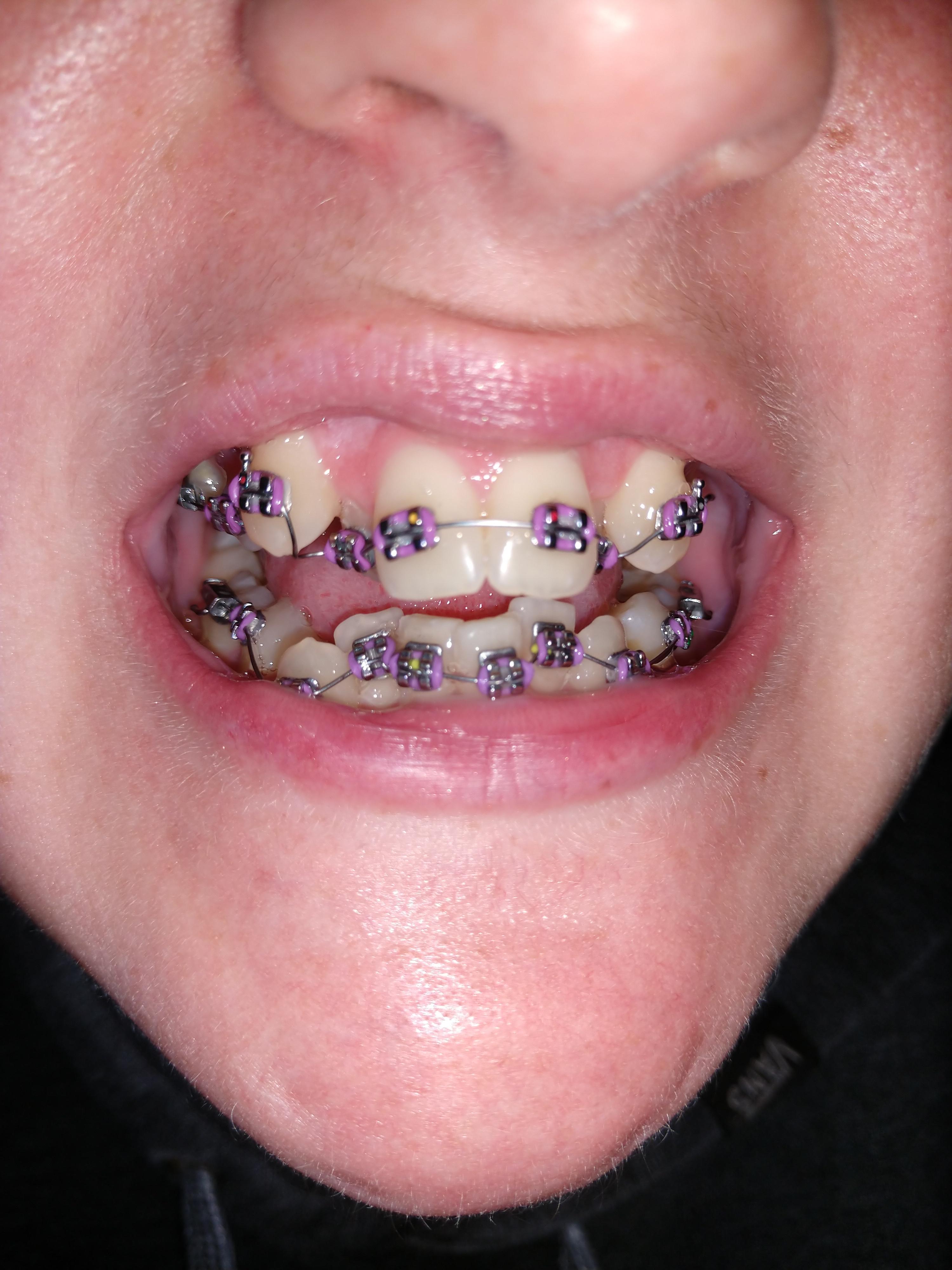 Braces at 26. First full day of braces, 5 days after having 6 teeth ...