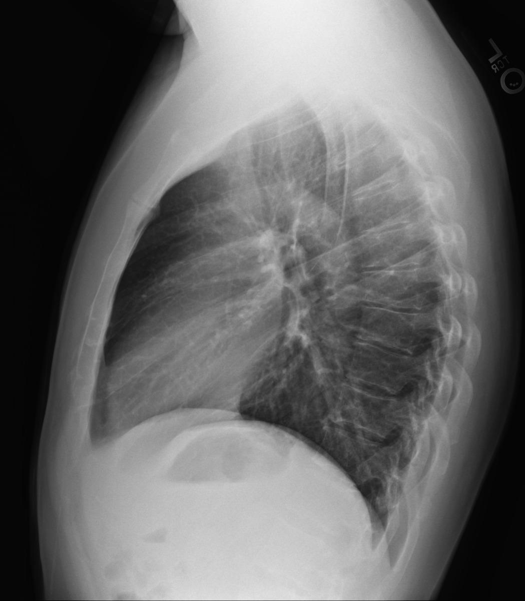 Broken Rib? Maybe rib 4 or 5? | Scrolller