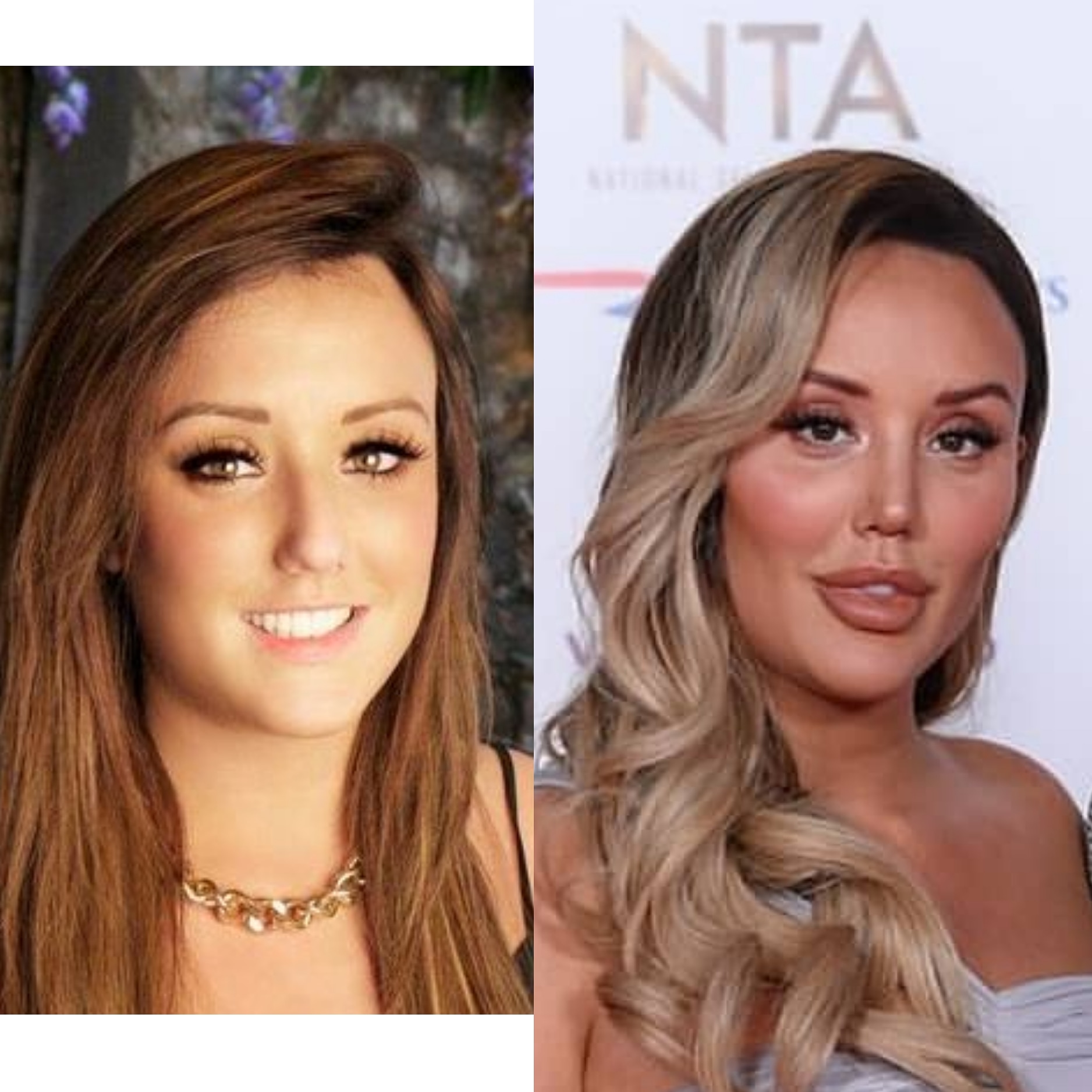 Charlotte Before And After Fillers Scrolller