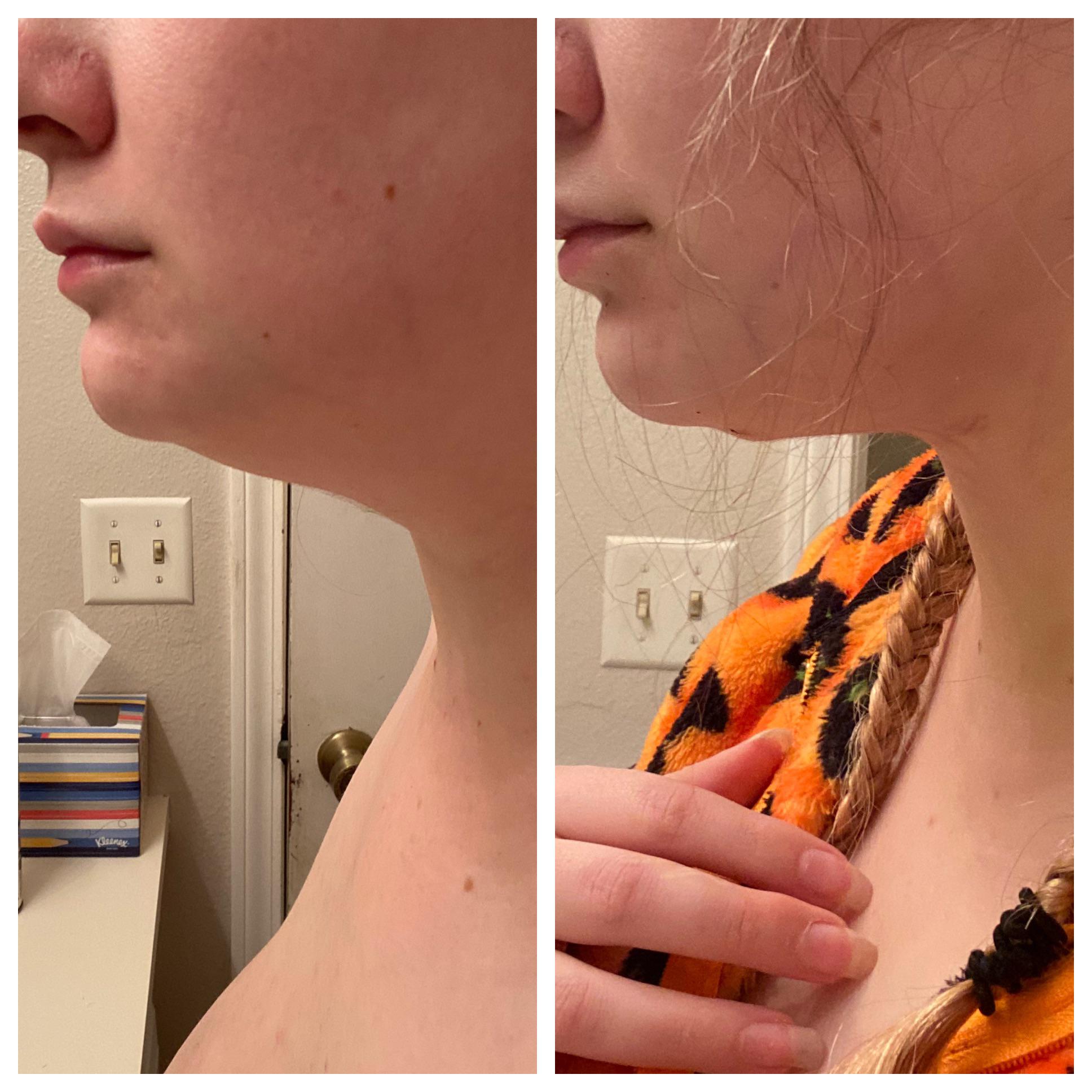 Chin Lipo 3 days post op Scrolller