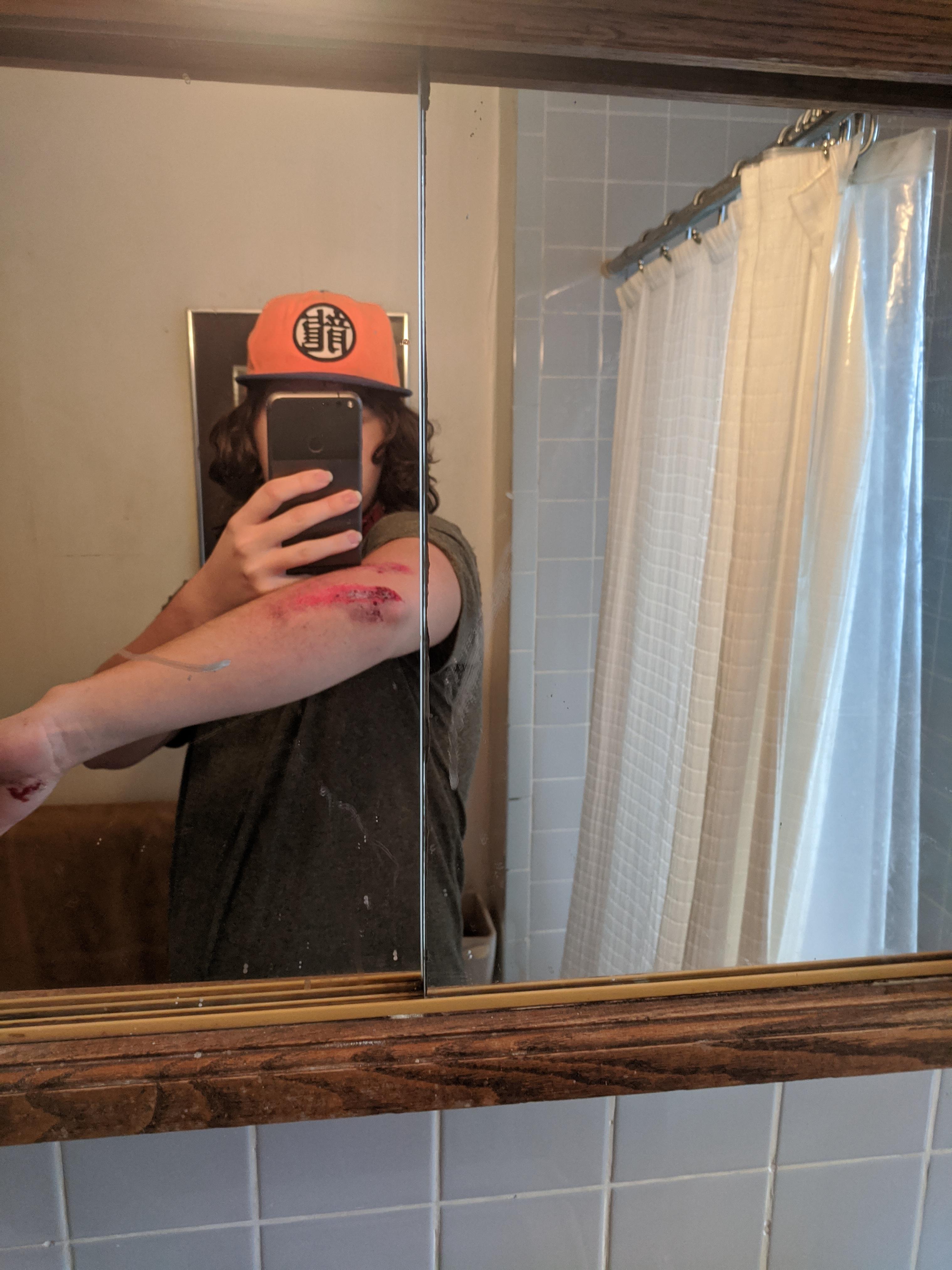 First skateboard injury, also got a sprained wrist Scrolller
