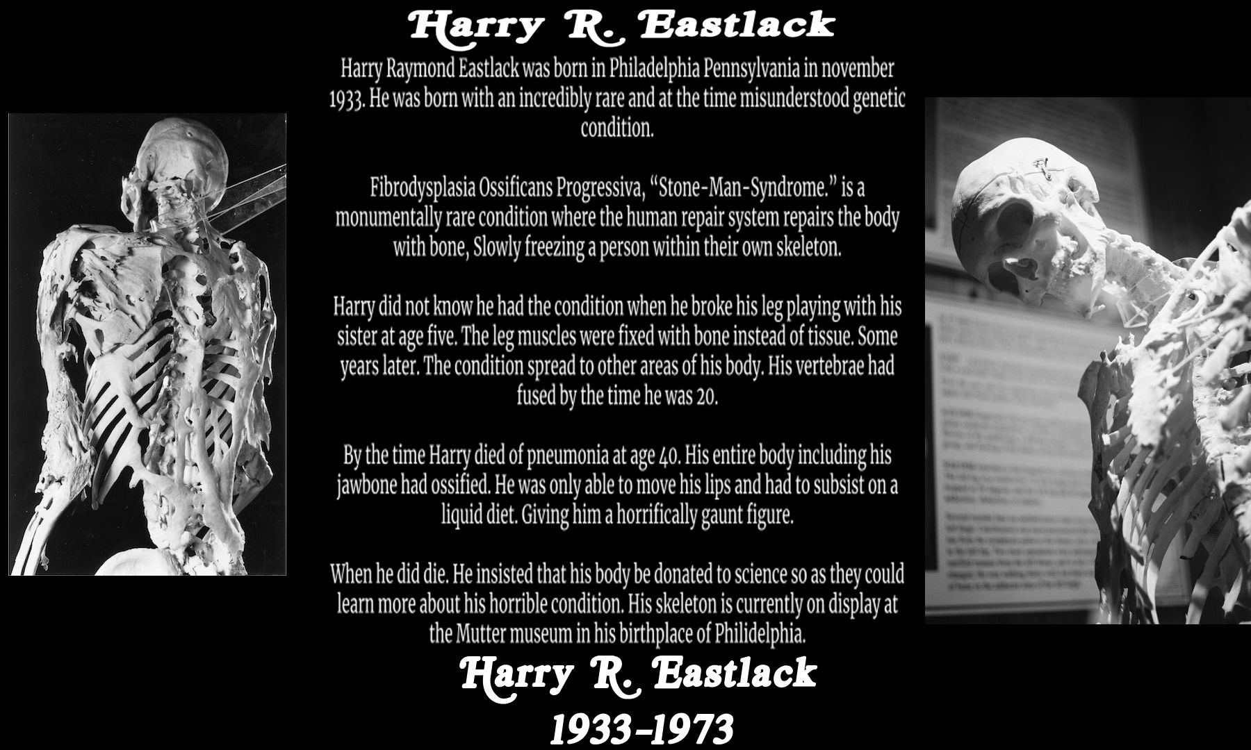 Freak Of the Week: Harry Eastlack | Scrolller