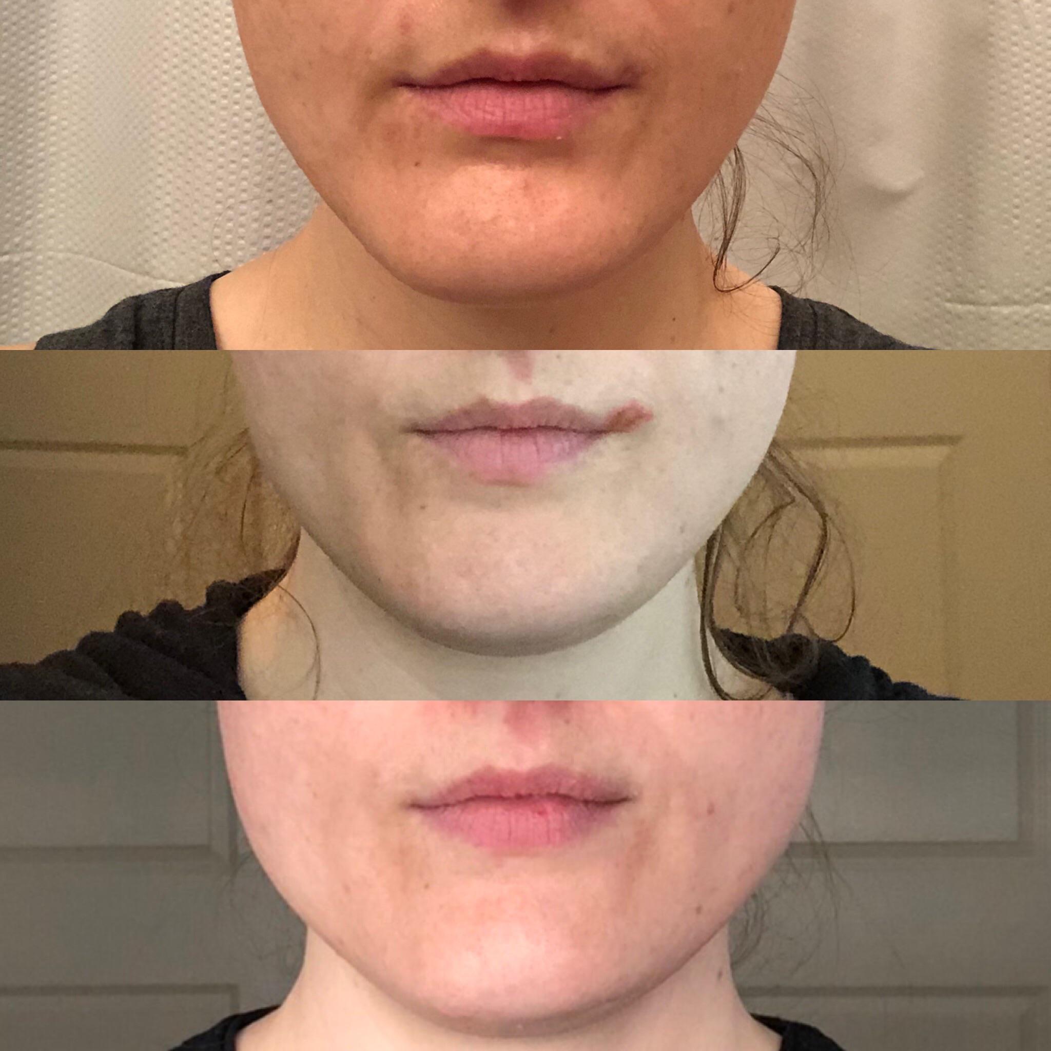 Masseter Botox Photos Before And Weeks After Units Each Side Scrolller