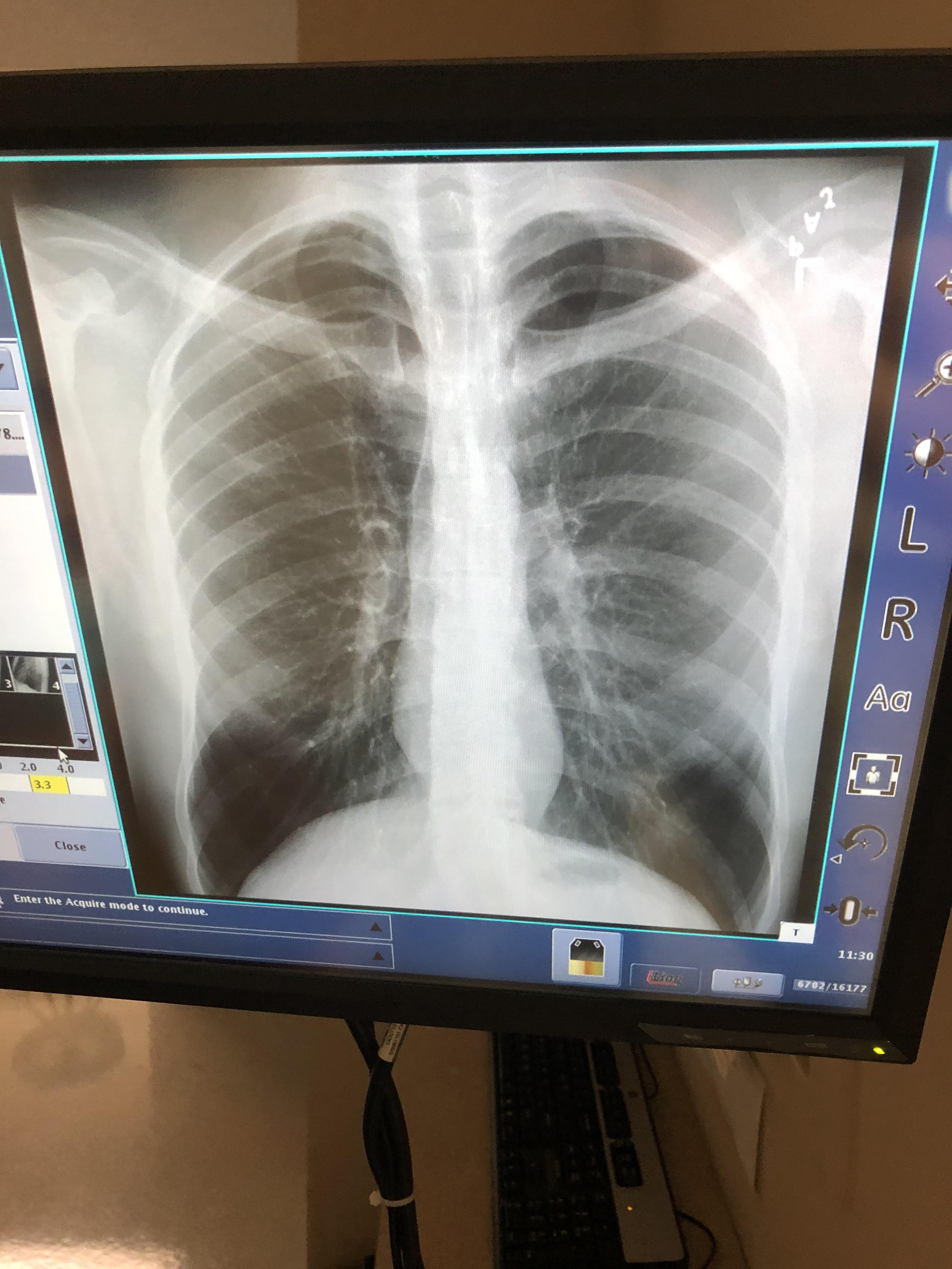 My Chest Xray Scrolller
