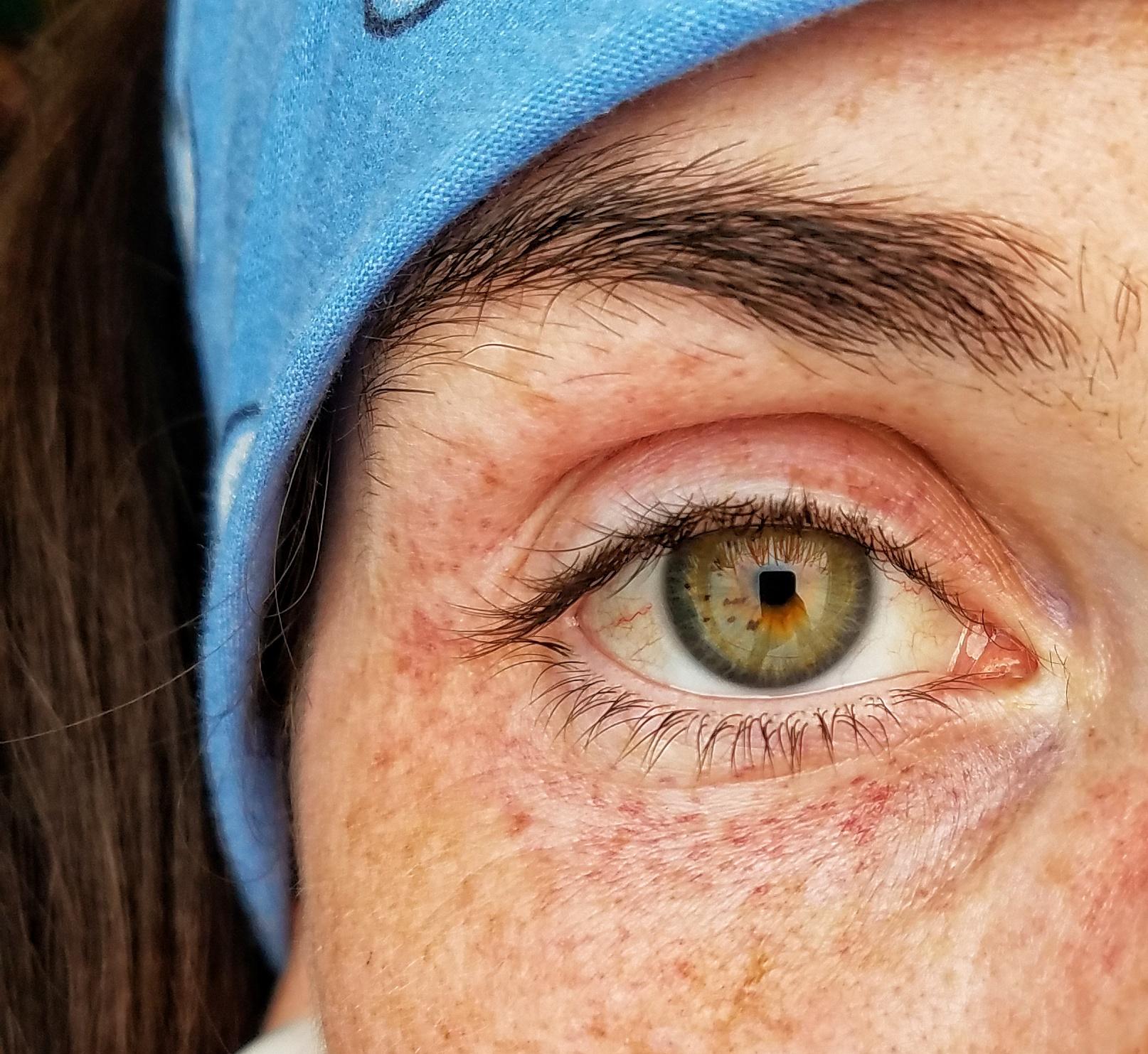 petechia-little-red-dots-around-my-eyes-probably-from-the-outstanding
