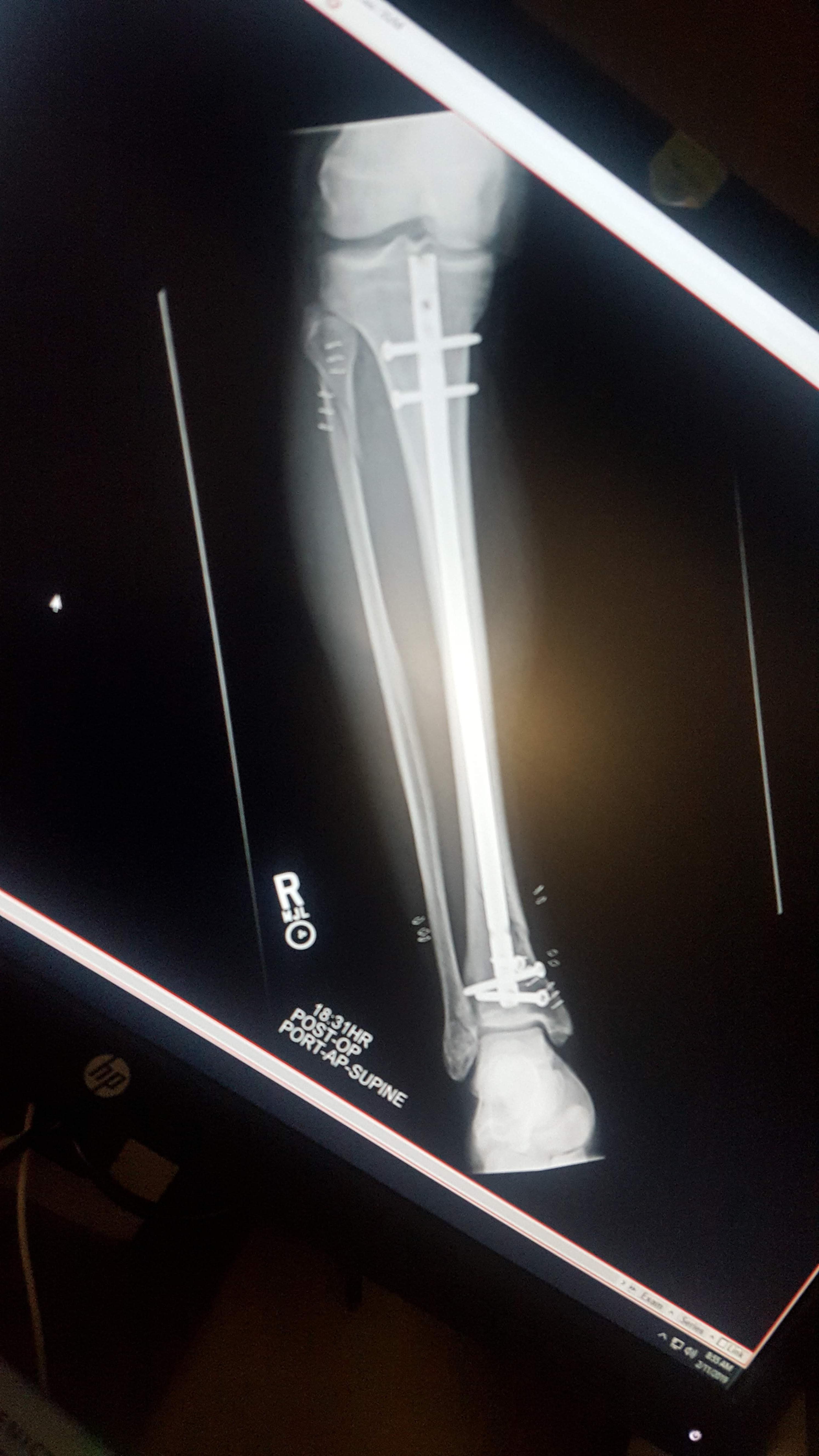 Post op after I fractured my tib and fib. One rod and 5 screws | Scrolller