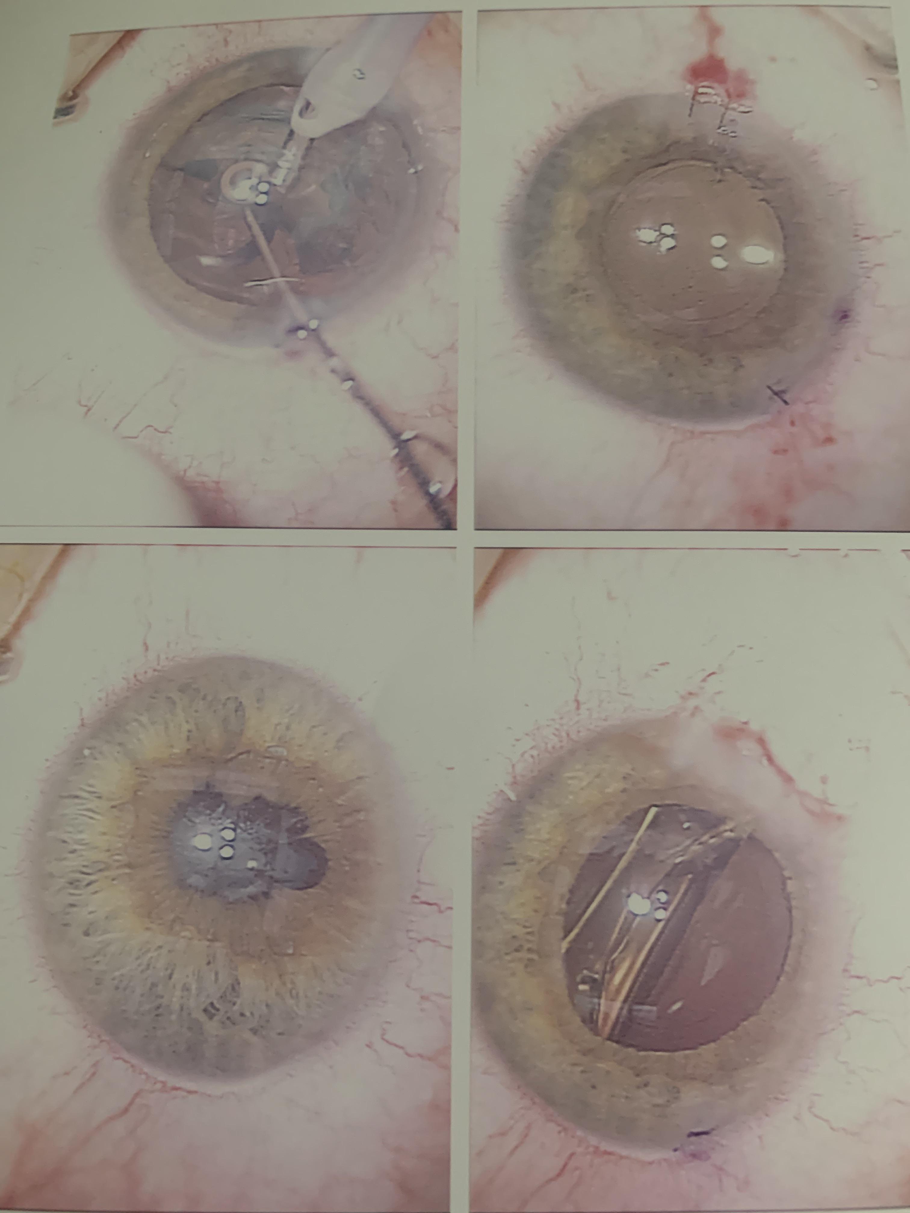 Removing a cataract and replacing lens Scrolller