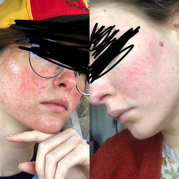 Skin after 5 months on Benlysta 💜👏🏻💜 it’s finally working!! | Scrolller