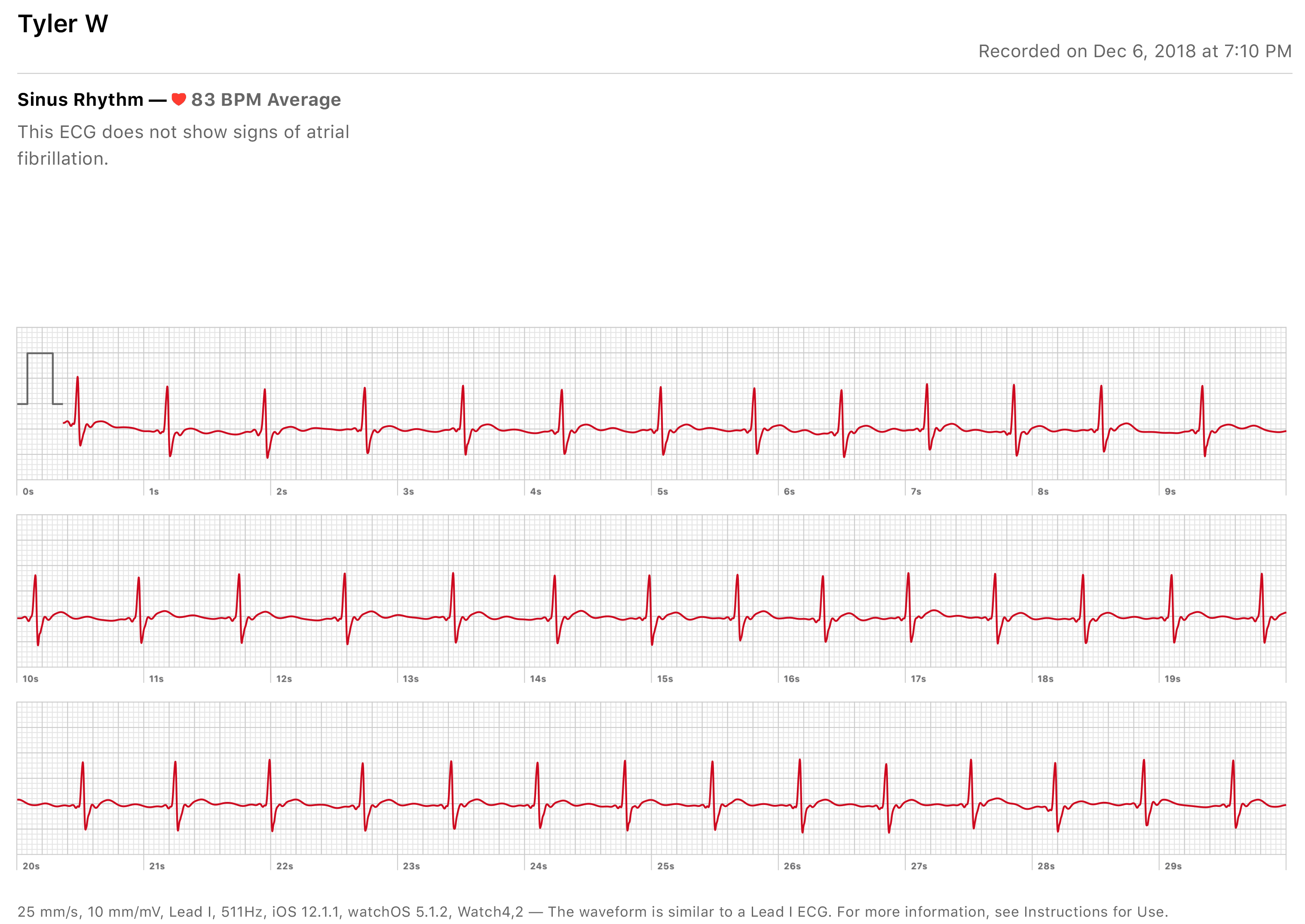 this-is-what-an-apple-watch-ecg-looks-like-scrolller