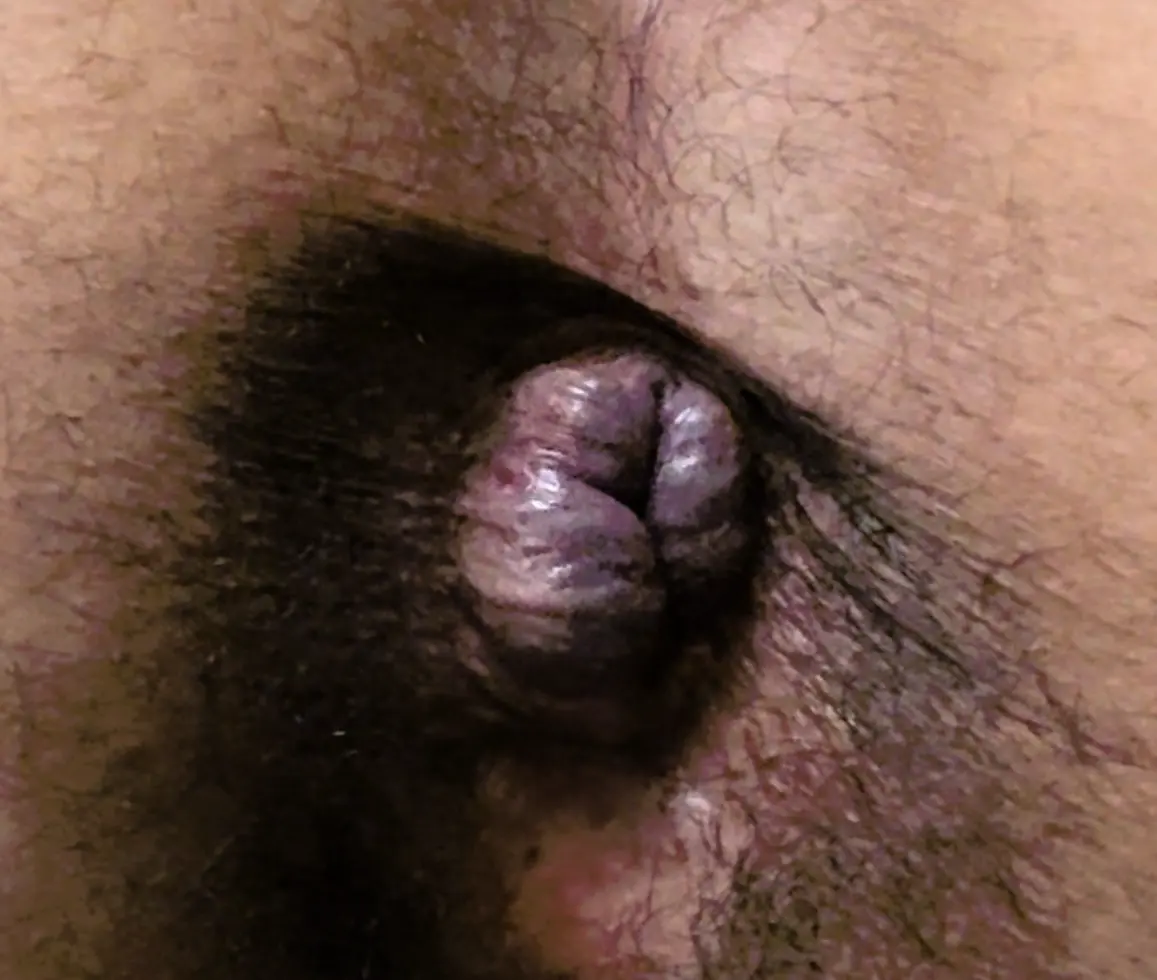 (Warning Pic) is this a prolapse? Or hem.