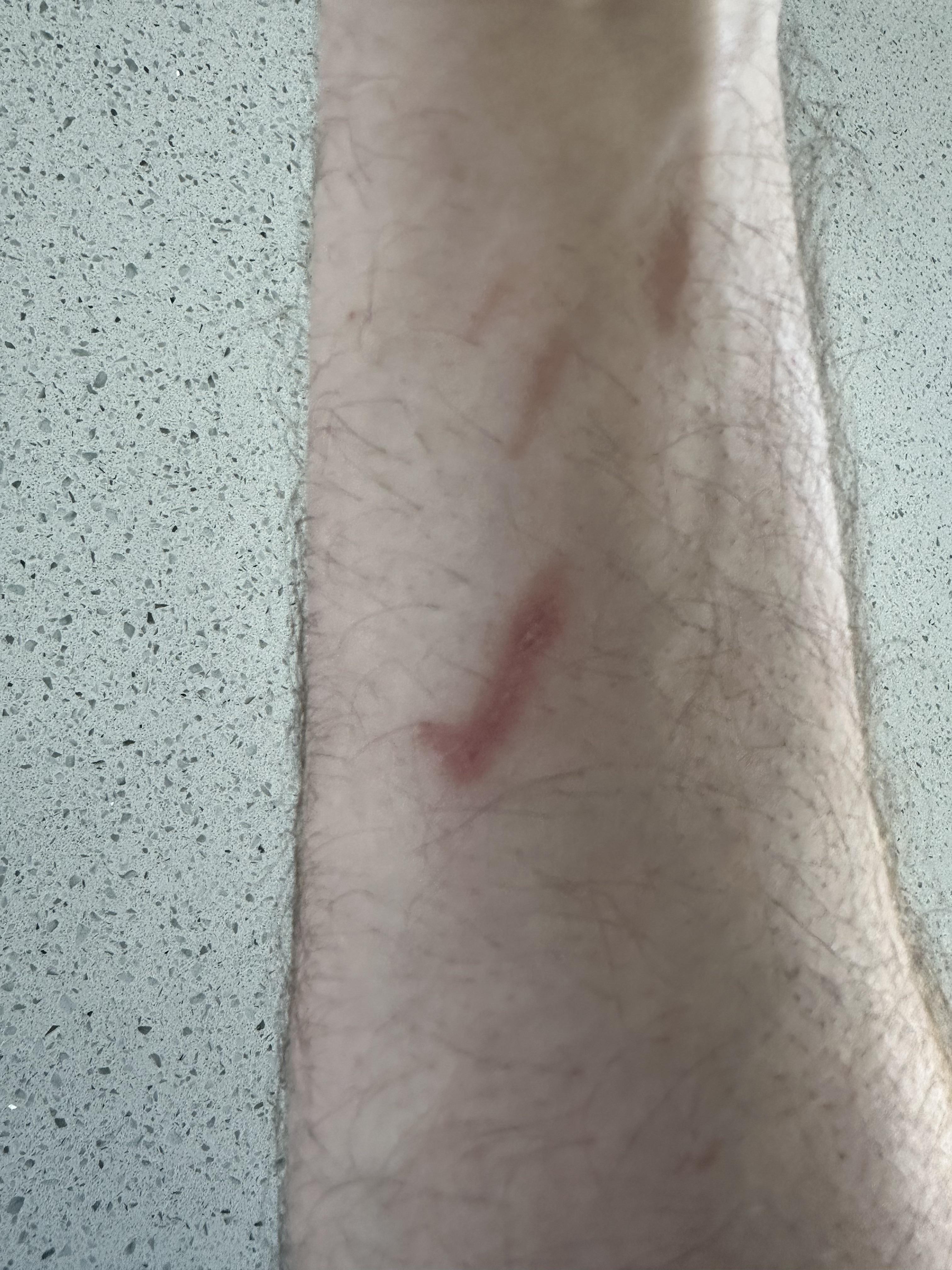 My burn looks like a check mark | Scrolller
