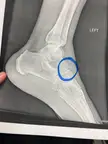 Avulsion Fracture of the Navicular