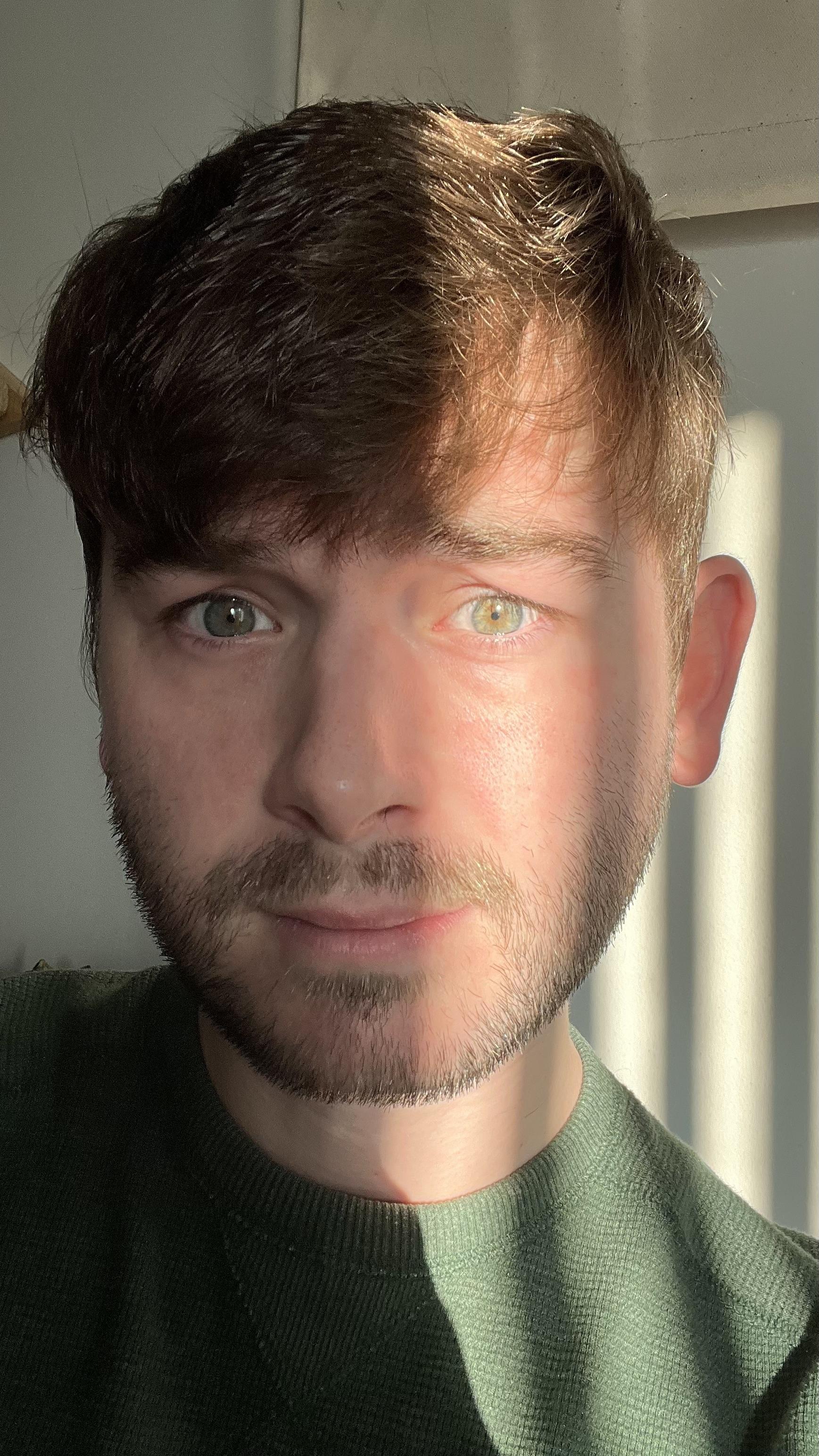 I’ve never been able to tell if I have Hazel eyes or Green eyes with a large central heterochromia