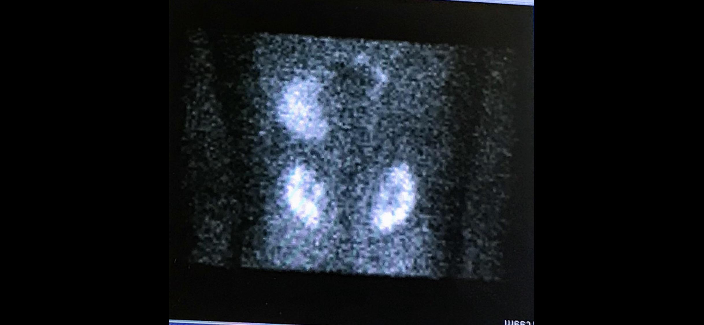 More X-ray - kidney transplant - my dad got a kidney transplant, you can see the extra kidney after the transplant. They leave the old kidney since they offer some function.
