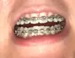 Braces are supposed to come off but why are my teeth different lengths ? Can this be fixed ?