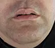 1st laser hair removal down 