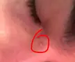 small bump on side of the bridge of my nose that won’t go away?