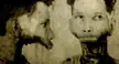 [50/50] Old photo of a man (SFW) | Man missing his entire lower jaw (NSFW)