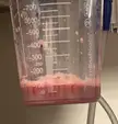 Close-up of a CardinalHealth medical drainage container filled with reddish-pink pussy juice and sediment.