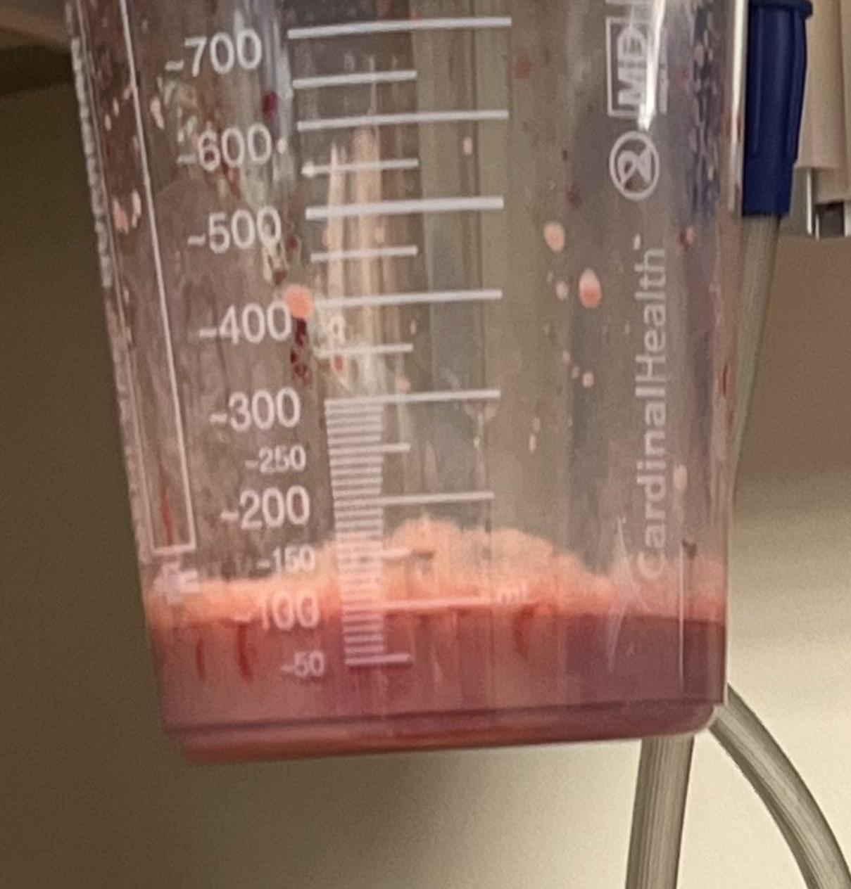 They wouldn’t film the procedure but this is 100ml or certified ass puss