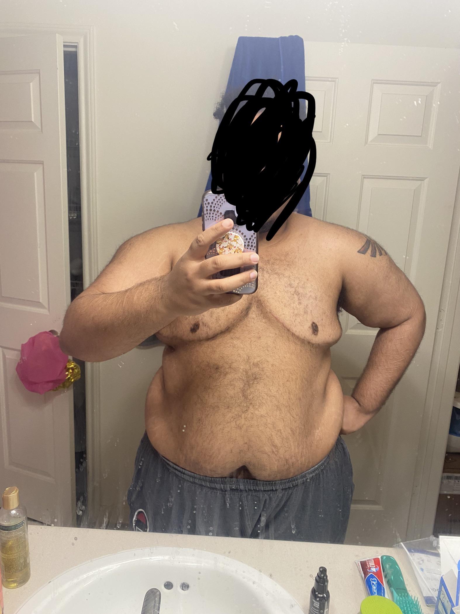 A year and some change post top surgery by Dr. Kitzmiller at the university of Cincinnati medical center. I think it might be time for a revision as my pecs have some loose skin and the dog ears. What do y’all think?