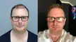 5100 GRAFTS / FUE HAIR TRANSPLANT / 12 MONTHS BEFORE AFTER RESULTS / DR. FIRDAVS AHMEDOV