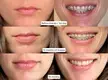 Before and after: 15 months of braces for class/2/2 malocclusion (deep bite)