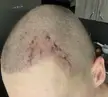 Bleeding after scab removal