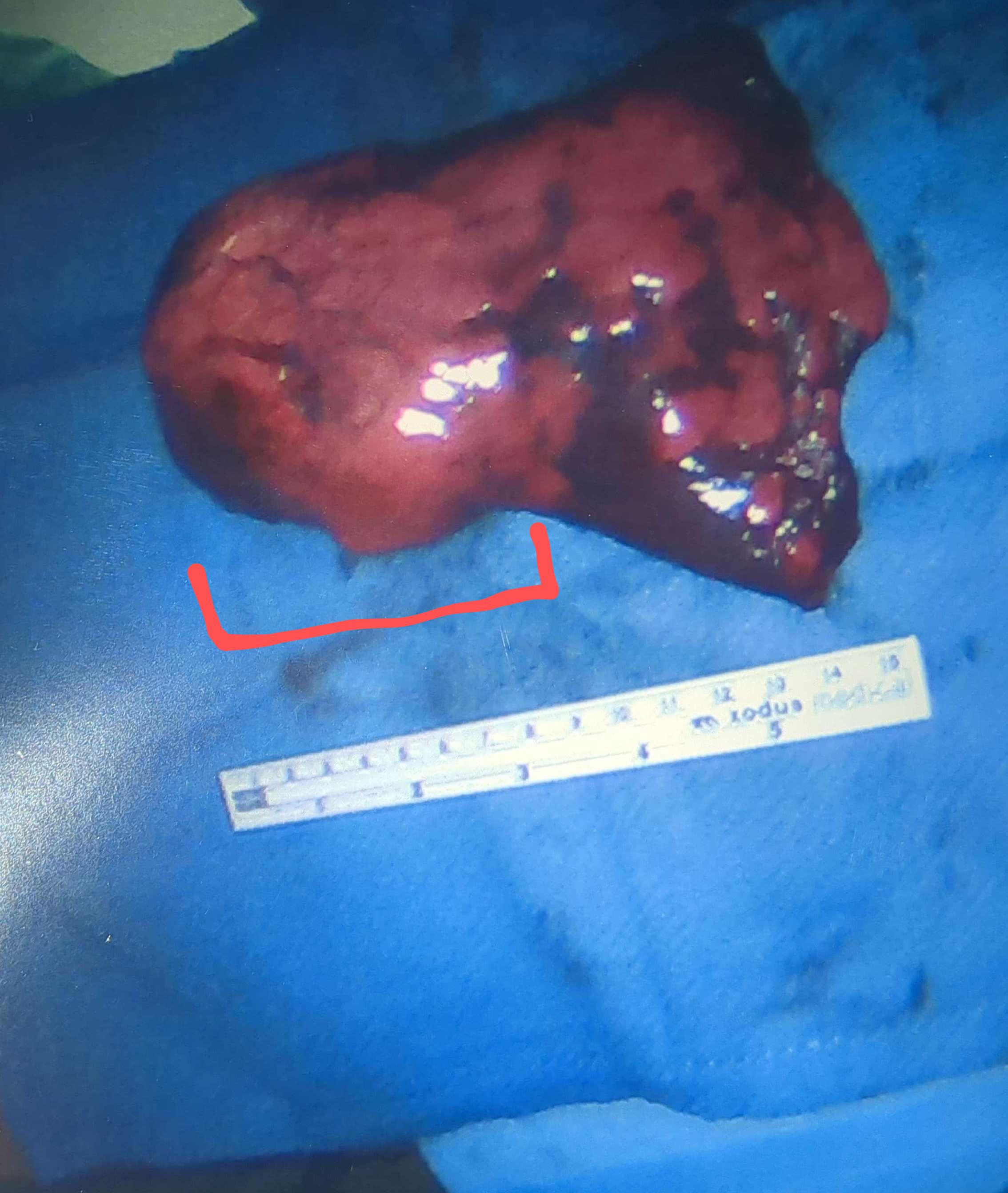 8cm+ metastasis of recurrent Osteosarcoma removed from the left lung